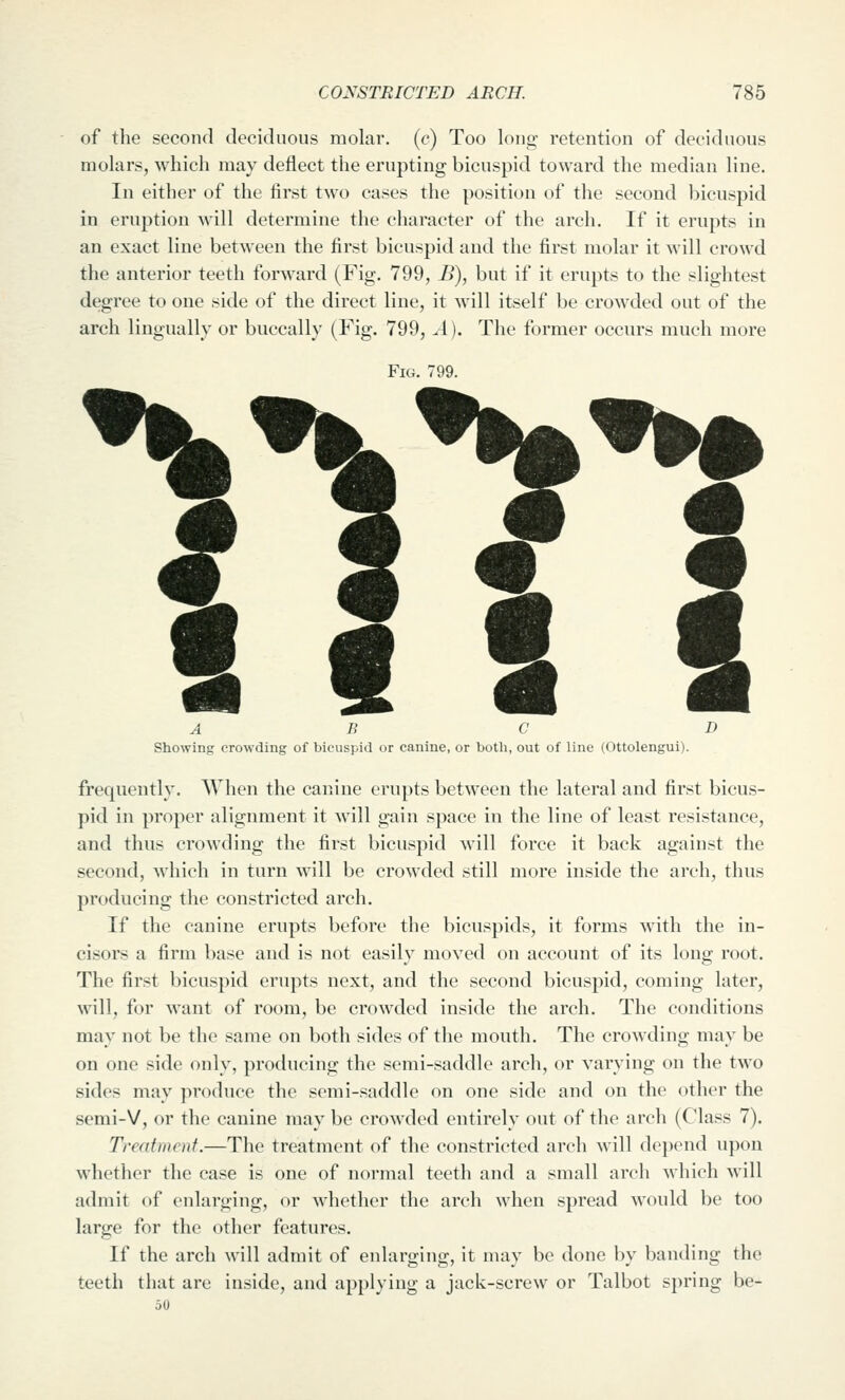 of the second decidiious molar, (c) Too long- retention of deciduous molars, which may deflect the erupting bicuspid toward the median line. In either of the first two cases the position of the second bicuspid in eruption will determine the character of the arch. If it erupts in an exact line between the first bicuspid and the first molar it will crowd the anterior teeth forward (Fig. 799, B), but if it erupts to the slightest degree to one side of the direct line, it wall itself be crow^ded out of the arch lingually or buccally (Fig. 799, A). The former occurs much more %^ Fig. 799. Showing crowding of bicuspid or canine, or both, out of line (Ottolengui). frequently. When the canine erupts between the lateral and first bicus- pid in proper alignment it will gain space in the line of least resistance, and thus crowding the first bicuspid will force it back against the second, which in turn will be crowded still more inside the arch, thus producing the constricted arch. If the canine erupts before the bicuspids, it forms with the in- cisors a firm base and is not easily moved on account of its long root. The first bicuspid erupts next, and the second bicuspid, coming later, will, for want of room, be crowded inside the arch. The conditions may not be the same on both sides of the mouth. The crowding may be on one side only, producing the semi-saddle arch, or varying on the two sides may produce the semi-saddle on one side and on the other the semi-V, or the canine may be crowded entirely out of the arch (Class 7). Treatment.—The treatment of the constricted arch w^ill de})end upon w^hether the case is one of normal teeth and a small arch which will admit of enlarging, or whether the arch when spread would be too large for the other features. If the arch will admit of enlarging, it may be done by banding the teeth that are inside, and applying a jack-screw or Talbot spring be-