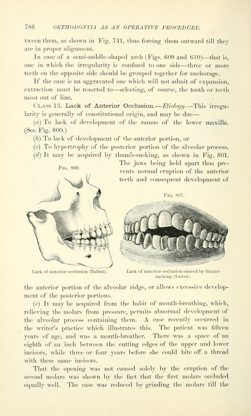 tween them, as .shown in Fig. 741, thus forcing them outward till thcv are in proper alignnu'nt. In case of a semi-saddle-shaped arch (Figs. 609 and 610)—that is, one in which the irregularity is confined to one side—three or more teeth on the opposite side should be groujied together for anchorage. If the case is an aggravated one wiiich will not admit of expansion, extraction must be resorted to—selecting, of course, the tooth or teeth most out of line. Class 13. Lack of Anterior Occlusion.—Etiology.—This irregu- larity is generally of constitutional origin, and may be due— (a) To lack of development of the ramus of the lower maxilla. (See Fig. 800.) (6) To lack of development of the anterior portion, or (c) To hypertrophy of the posterior portion of the alveolar process. id) It may be acquired by thumb-sucking, as shown in Fig. 801. The jaws being held apart thus pre- vents normal eruption of the anterior teeth and consequent development of Fig. SOI. Fig. 800. Lack of anterior occlusion (Talbot). Lack of anterior occlusion caused by thumb- sucking (Talbot). the anterior portion of the alveolar ridge, or allows excessive develop- ment of the posterior portions. {e) It may be acquired from the habit of mouth-breathing, which, relieving the molars from pressure, permits abnormal development of the alveolar process containing them. A case recently occurred in the writer's practice which illustrates this. The patient was fifteen years of age, and was a mouth-breather. There Avas a space of an eighth (jf an inch between the cutting edges of the upper and lower incisors, wdiile three or four years before she could bite off a thread with these same incisors. That the opening w^as not caused solely by the eruption of the second molars was shown by the fact that the first molars occluded equally well. The case was reduced by grinding the molars till the