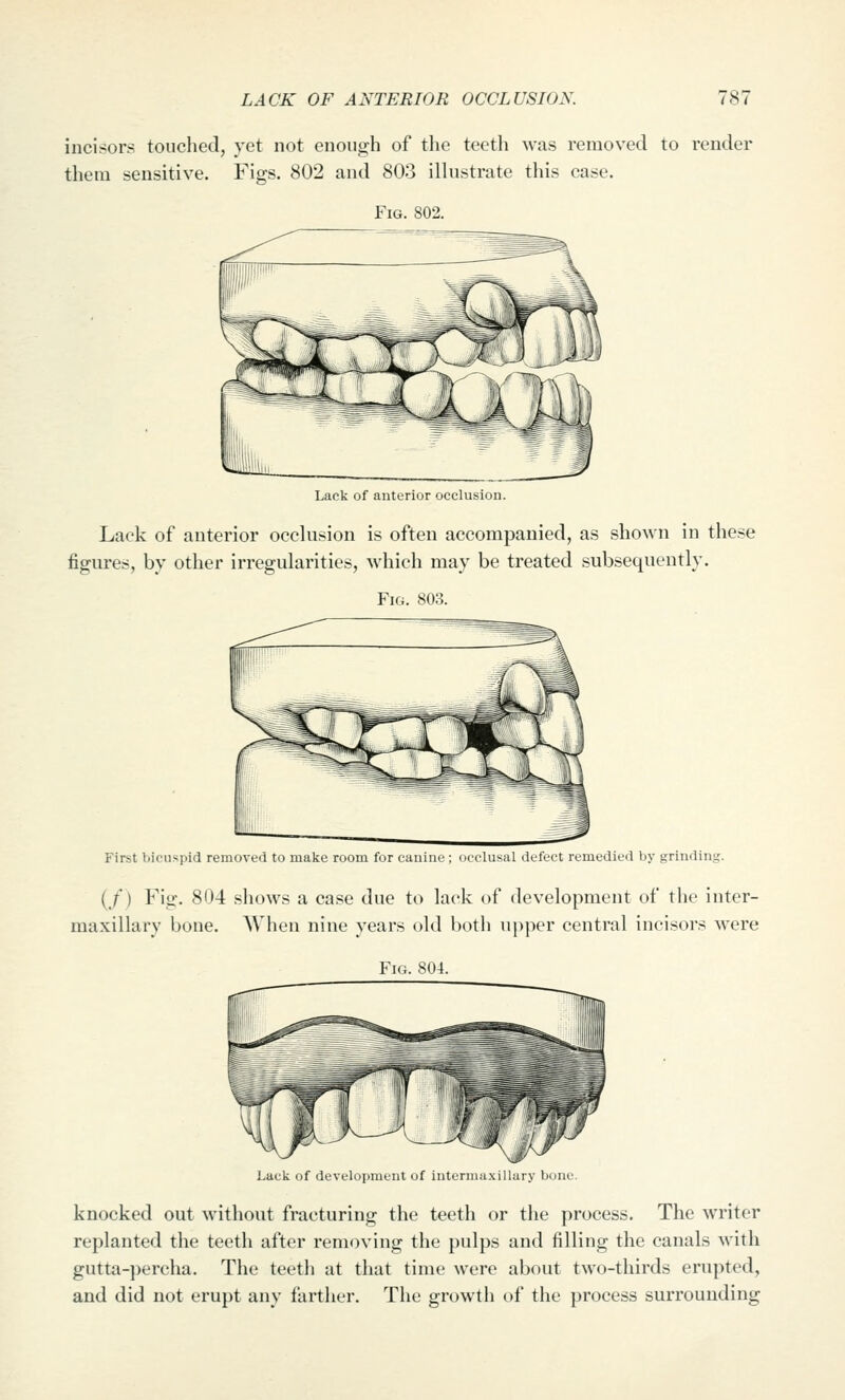 LACK OF ANTERIOR OCCLUSION. 1^1 incisors touched, yet not enough of the teeth was removed to render them sensitive. Figs. 802 and 803 illustrate this case. Fig. 802. Lack of anterior occlusion. Lack of anterior occlusion is often accompanied, as shown in these figures, by other irregularities, which may be treated subsequently. Fig. 803. First bicuspid removed to make room for canine ; occlusal defect remedied by grinding. (/) Fig. 804 shows a case due to lack of development of the inter- maxillary bone. When nine years old both upper central incisors were Fig. 804. Lack of development of intermaxillary bone. knocked out without fracturing the teeth or the process. The writer replanted the teeth after removing the pulps and filling the canals with gutta-])ercha. The teeth at that time were about two-thirds erupted, and did not erupt any farther. The growth of the process surrounding