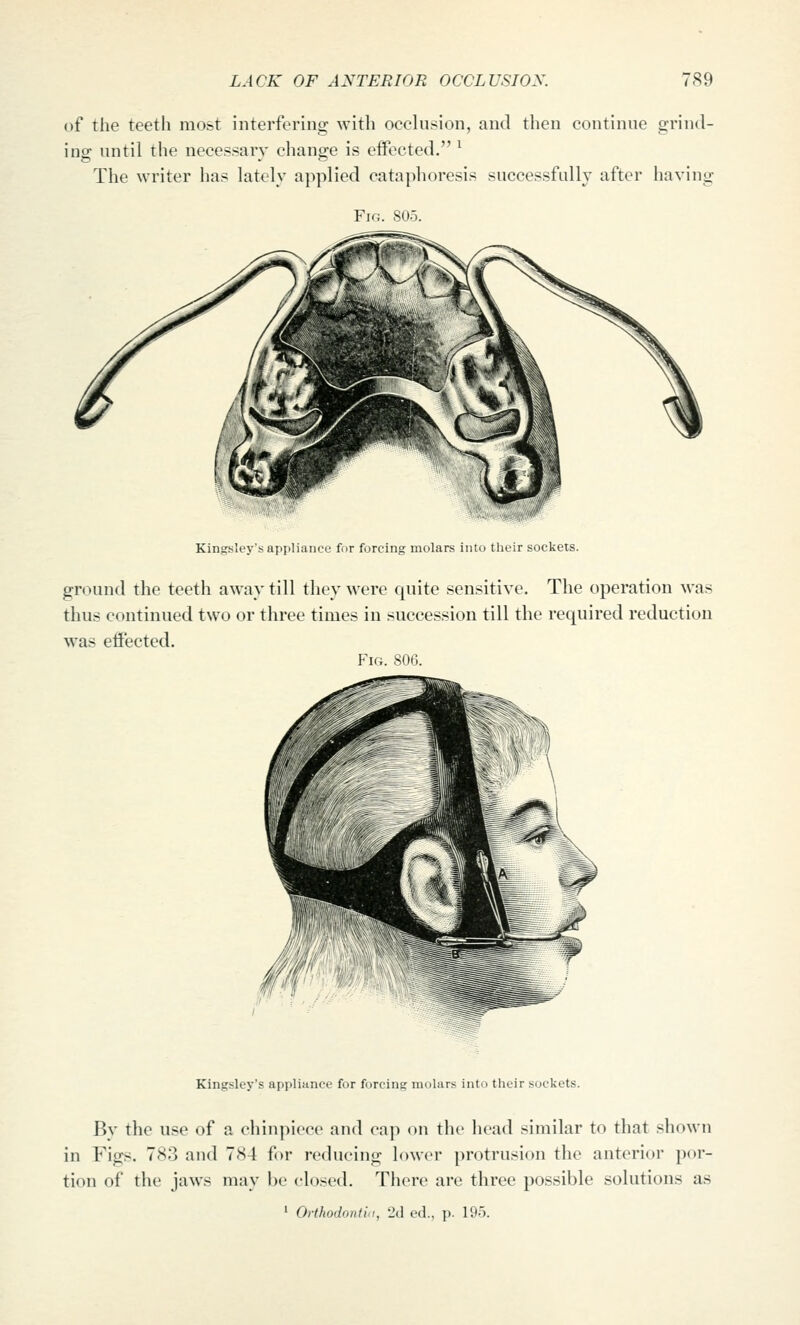 of the teeth most interfering with occlusion, and then continue grind- ing until the necessary cliange is eifocted. ^ The writer has lately applied cataphoresis successfully after having Fig. 805. Kingsley's appliance for forcing molars into their sockets. ground the teeth away till they were quite sensitive. The operation was thus continued two or three times in succession till the required reduction was eiFected. Fio. 806. Kingsley's appliance for forcinc molars into their sockets. Bv the use of a chinpiece and cap on the head similar to that shown in Figs. 783 and 784 for reducing lower protrusion the anterior por- tion of the jaws may be closed. There are three possible solutions as ' Orthodontli, 'Jd ed., p. 195.