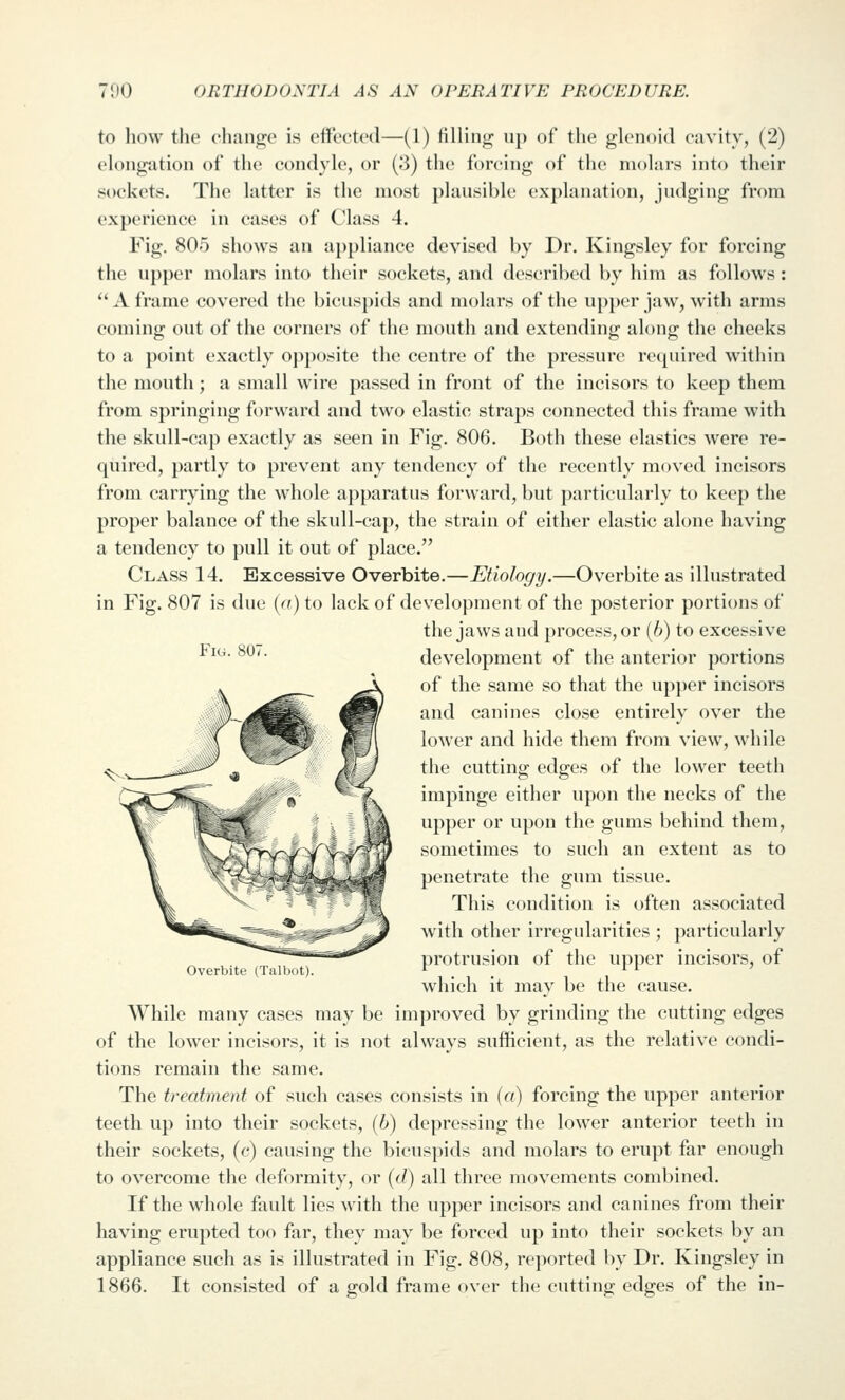 Fig. 807. to how the change is effected—(1) filling up of the glenoid cavity, (2) elongation of the condyle, or (3) the forcing of the molars into their sockets. The latter is the most plausible explanation, judging from experience in cases of Class 4. Fig. 805 shows an appliance devised by Dr. Kingsley for forcing the upper molars into their sockets, and described by him as follows : '' A frame covered the bicuspids and molars of the upper jaw, with arras coming out of the corners of the mouth and extending along the cheeks to a point exactly opposite the centre of the pressure required within the mouth; a small wire passed in front of the incisors to keep them from springing forward and two elastic straps connected this frame with the skull-cap exactly as seen in Fig. 806. Both these elastics were re- quired, partly to prevent any tendency of the recently moved incisors from carrying the whole apparatus forward, but particularly to keep the proper balance of the skull-cap, the strain of either elastic alone having a tendency to pull it out of place. Class 14. Excessive Overbite.—Etiology.—Overbite as illustrated in Fig. 807 is due (^?)to hick of development of the posterior portions of the jaws and process, or (6) to excessive development of the anterior portions of the same so that the upper incisors and canines close entirely over the lower and hide them from view, while the cutting edges of the lower teeth impinge either upon the necks of the upper or upon the gums behind them, sometimes to such an extent as to penetrate the gum tissue. This condition is often associated with other irregularities ; particularly protrusion of the upper incisors, of which it may be the cause. While many cases may be improved by grinding the cutting edges of the lower incisors, it is not always sufficient, as the relative condi- tions remain the same. The treatment of such cases consists in («) forcing the upper anterior teeth up into their sockets, (6) depressing the lower anterior teeth in their sockets, (c) causing the bicuspids and molars to erupt far enough to overcome the deformity, or ((/) all three movements combined. If the whole fault lies with the upper incisors and canines from their having erupted too far, they may be forced up into their sockets by an appliance such as is illustrated in Fig. 808, reported by Dr. Kingsley in 1866. It consisted of a gold frame over the cutting edges of the in- Overbite (Talbot).