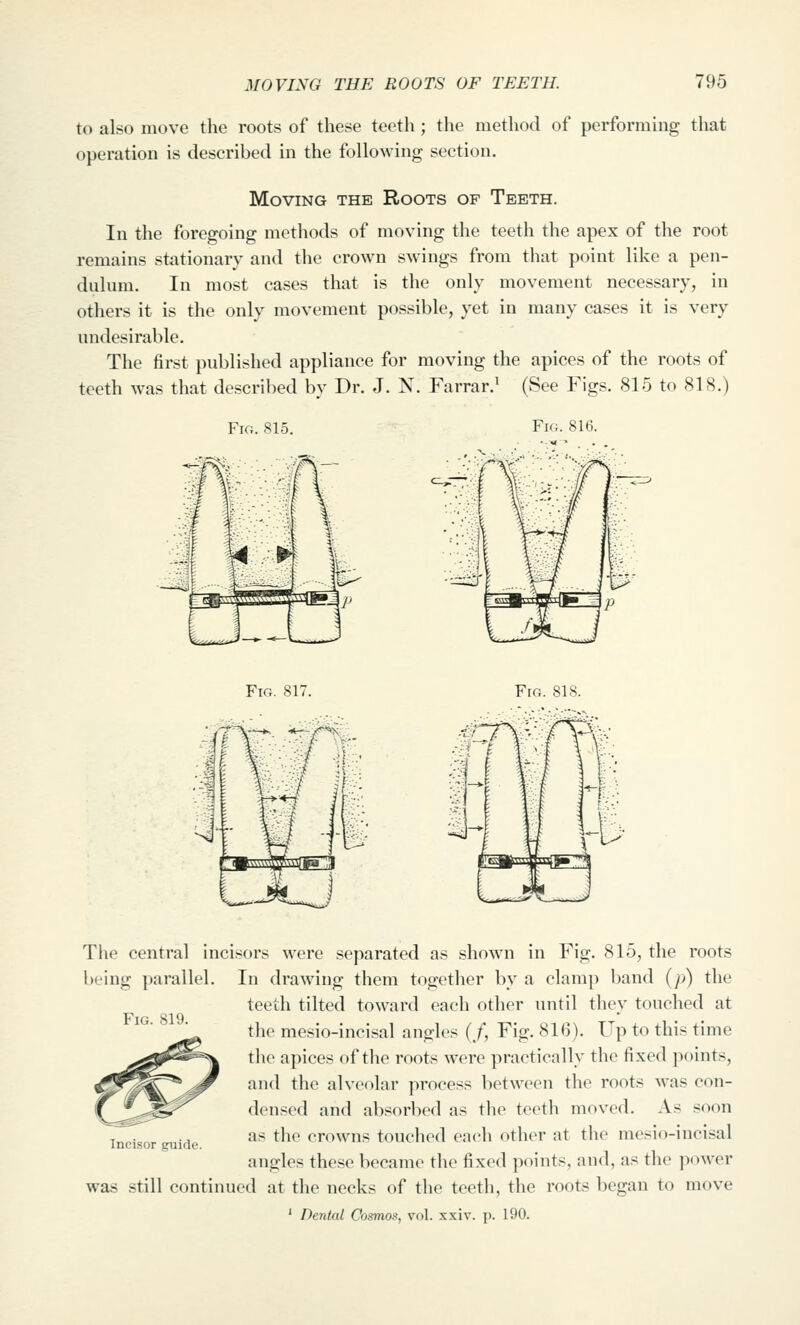 to also move the roots of these teeth; the method of performing that operation is described in the following section. Moving the Roots of Teeth. In the foregoing methods of moving the teeth the apex of the root remains stationary and the crown swings from that point like a pen- dulum. In most cases that is the only movement necessary, in others it is the only movement possible, yet in many cases it is very undesirable. The first published appliance for moving the apices of the roots of teeth was that described bv Dr. J. N. Farrar.' (See Figs. 815 to 818.) Fig. 815. Fk;. 816. Fio. 817. Fig. 818. -^^-^ Fig. 819. The central incisors were separated as shown in Fig. 815, the roots being parallel. In drawing them together by a clamp band (/>) the teeth tilted toward each other until they touched at the mesio-incisal angles (/, Fig. 816). Up to this time the apices of the roots were practically the fixed points, and the alveolar process between the roots was con- densed and absorbed as the teeth moved. As soon as the crowns touched eadi other at tlio mesio-incisal angles these became the fixed points, and, as the power was still continued at the necks of the teeth, the roots began to move ' Dental Cosmos^, vol. xxiv. p. 190. Incisor guide.