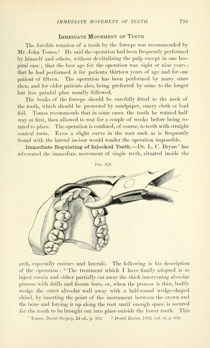 Immediate Movement of Teeth. The forcible rotation of a tootli bv the forceps was recommended by Mr. John Tomes.' He said the operation had been frequently performed by himself and others, without devitalizing the pulp except in one hos- pital case ; that the best age for the operation was eight or nine years ; that he had performed it for patients thirteen years of age and for one patient of fifteen. The operation has been performed by many since then, and for older patients also, being preferred by some to the longer but less painful plan usually followed. The beaks of the forceps should be carefully fitted to the neck of the tooth, which should be protected by sandpaper, emery cloth or lead foil. Tomes recommends that in some cases the tooth be rotated half way at first, then allowed to rest for a couple of weeks before being ro- tated to place. The operation is confined, of course, to teeth with straight conical roots. Even a slight curve in the root such as is frequently found with the lateral incisor would render the operation impossible. Immediate Regulating- of Inlocked Teeth.—Dr. L. C. Bryan'' has advocated the immediate movement of single teeth, situated inside the Fiu. 828. arch, especially canines and laterals. The following is his description of the operation :  The treatment which I have finally adopted is to inject cocain and either partially cut away the thick intervening alveolar process with drills and fissure burs, or, when the process is thin, bodily wedge the outer alveolar wall away with a half-round wedge-shaped chisel, by inserting the point of the instrument between the crown and the bone and forcing it up along the root until enough space is secured for the tooth to be brought out into place outside the lower tooth. This ' Tomes, Denial Sunjery, 2d ed., p. 1G2. '^ Dental Review, 1892, vol. vi. p. 859.