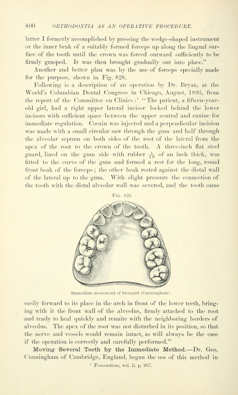 latter I fnrinorly ivccoiupHshod by })r('ssiii(;' tlic wi'dj^e-shaped instrument or the inner beak of a suitably formed ibreeps up aloii<>; the liniijual sur- face of the tooth until the crown was forced outward sutliciently to be firmly grasped. It was then brought gradually out into place. Another and better plan was by the use of forceps specially made for the purpose, shown in Fig. 828. Following is a description of an o|)crati()n by Dr. l>ryan, at the World's Columbian Dental Congress in Chicago, August, 189.3, from the report of the Committee on Clinics :'  The patient, a fifteen-year- old girl, had a right upper lateral incisor locked behind the lower incisors with sufficient space between the upper central and canine for immediate regulation. Cocain was injected and a perpendicular incision was made with a small circular saw through the gum and half through the alveolar septum on both sides of the root of the lateral from the apex of the root to the crown of the tooth. A three-inch flat steel guard, lined on the gum side with rubber ^^g- of an inch thick, was fitted to the curve of the gum and formed a rest for the long, round front beak of the forceps; the other beak rested against the distal wall of the lateral up to the gum. With slight pressure the connection of the tooth with the distal alveolar wall was severed, and the tooth came Fig. 829. Immediate movement of bicuspid (Cunningham). easily forward to its place in the arch in front of the lower teeth, bring- ing with it the front wall of the alveolus, firmly attached to the root and ready to heal quickly and reunite with the neighboring borders of alveolus. The apex of the root was not disturbed in its position, so that the nerve and vessels would remain intact, as will always be the case if the operation is correctly and carefully performed. Moving- Several Teeth by the Immediate Method.—Dr. Geo. Cunningham of Cambridge, England, began the use of this method in ^ Transactions, vol. ii. p. 997.