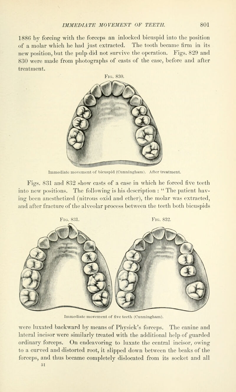 1886 by forcing with the forceps an inlocked bicuspid into the position of a molar which he had just extracted. The tooth became firm in its new position, but the pulp did not survive the operation. Figs. 829 and 830 were made from photographs of casts of the case, before and after treatment. Fh;. S80. Immediate movement of bicuspid (Cunningham). After treatment. Figs. 831 and 832 show casts of a case in which he forced five teeth into new positions. The following is his description :  The patient hav- ing been anesthetized (nitrous oxid and ether), the molar was extracted, and after fracture of the alveolar process between the teeth both bicuspids Fig. 832. Immediate movem.ent of five teeth (Cunningham). were luxated backward by means of Physick's forceps. The canine and lateral incisor were similarly treated with the additional help of guarded ordinary forceps. On endeavoring to luxate the central incisor, owing to a curved and distorted root, it slipped down between the beaks of the forceps, and thus became completely dislocated from its socket and all 51