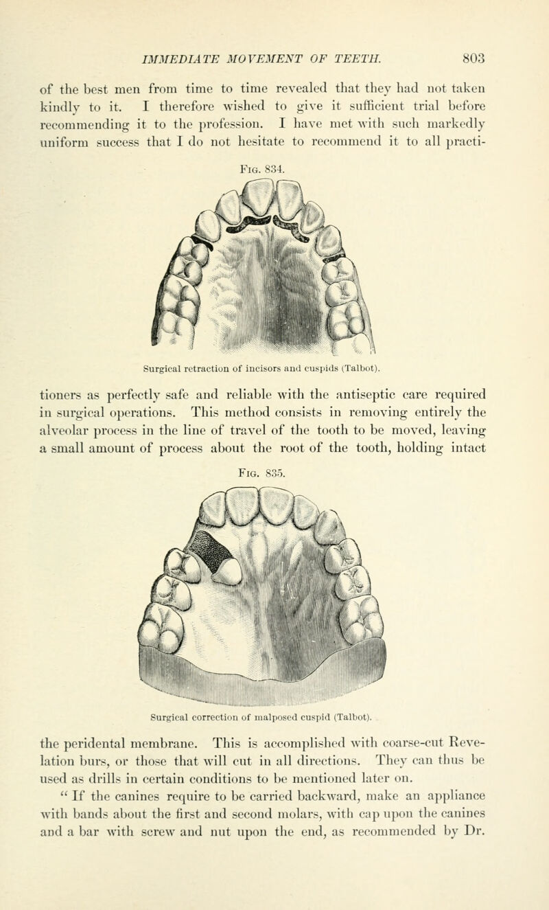 of the best men from time to time revealed that they had not taken kindly to it. I therefore wished to give it sufficient trial before recommending it to the profession. I have met with such markedly uniform success that I do not hesitate to recommend it to all practi- FiG. 834. Surgical retraction of incisors and cuspids tTalbot). tioners as perfectly safe and reliable with the antiseptic care required in surgical operations. This method consists in removing entirely the alveolar process in the line of travel of the tooth to be moved, leaving a small amount of process about the root of the tooth, holding intact Fig. 835. ^**»Willlll.ail!l!ill!!i!l!lllllllill''l!l^ Surgical correction of malposed cuspid (Talbot). the peridental membrane. This is accomplished with coarse-cut Reve- lation burs, or those that will cut in all directions. They can thus be used as drills in certain conditions to be mentioned later on.  If the canines require to be carried backward, make an a]>pliance with bands about the first and second molars, with cap upon the canines and a bar with screw and nut upon the end, as recommended by Dr.