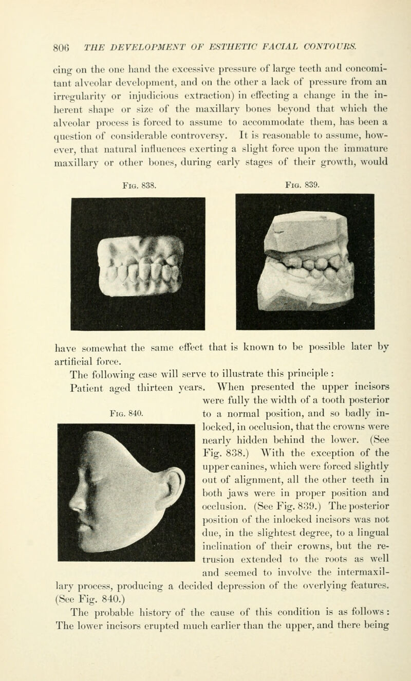 cing on the one luuid the excessive pressure of large teeth and concomi- tant alveolar development, and on the other a lack of pressure from an irregularity or injudicious extraction) in effecting a change in the in- herent shape or size of the maxillary bones beyond that which the alveolar process is forced to assume to accommodate them, has been a question of considerable controversy. It is reasonable to assume, how- ever, that natural influences exerting a slight force upon the immature maxillary or other bones, during early stages of their growth, would Fig. 838. Fig. 839. Fig. 840. have somewhat the same effect that is known to be possible later by artificial force. The following case will serve to illustrate this principle : Patient aged thirteen years. When presented the upper incisors were fully the width of a tooth posterior to a normal position, and so badly in- locked, in occlusion, that the crowns were nearly hidden behind the lower. (See Fig. 838.) With the exception of the upper canines, which were forced slightly out of alignment, all the other teeth in both jaws were in proper position and occlusion. (See Fig. 839.) The posterior position of the inlocked incisors was not due, in the slightest degree, to a lingual inclination of their crowns, but the re- trusion extended to the roots as well and seemed to involve the intermaxil- lary process, producing a decided depression of the overlying features. (See Fig. 840.) The probable history of the cause of this condition is as follows : The lower incisors erupted much earlier than the upper, and there being