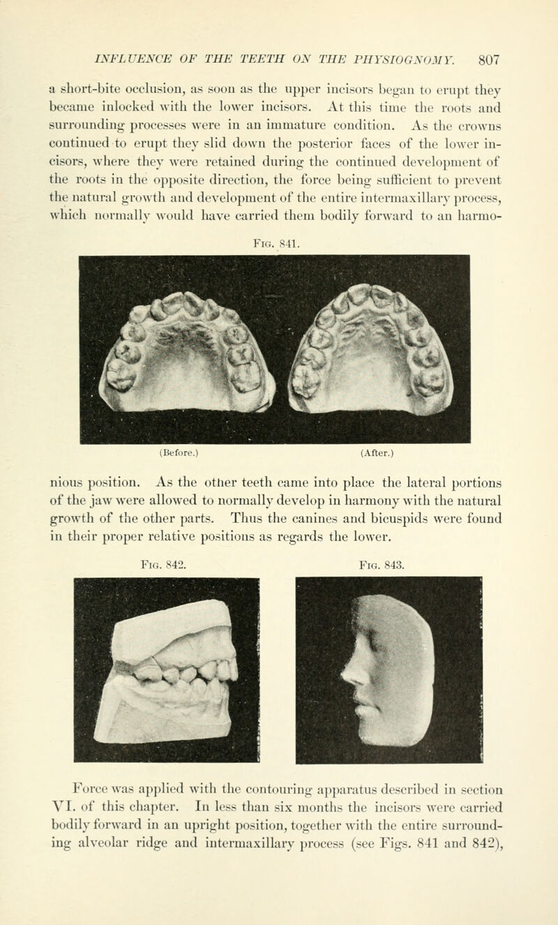 a short-bite occlusion, as soon as the upper incisors began to erupt they became inlocked Avith the lower incisors. At this time the roots and surrounding processes were in an immature condition. As the crowns continued to erupt they slid down the posterior faces of the lower in- cisors, where they were retained during the continued development of the roots in the opposite direction, the force being sufficient to prevent the natural growth and development of the entire intermaxillary process, which normally would have carried them bodily forward to an harmo- FiG. s-n. (Before.) (After.) nious position. As the other teeth came into place the lateral portions of the jaw were allowed to normally develop in harmony with the natural growth of the other parts. Thus the canines and bicuspids were found in their proper relative positions as regards the lower. Fm. S42. Fig. 843. Force was applied with the contouring apparatus described in section VI. of this chapter. In less than six months the incisors were carried bodily forward in an upright position, together with the entire surround- ing alveolar ridge and intermaxillary process (see Figs. 841 and 842),