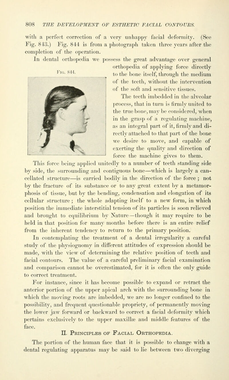 Fig. 844. with a perfect correction of a vciy unliappy facial (lefonnity. (See Fig. 8 43.) Fig. 844 is from a photograph taken three years after the completion of the operation. In dental orthopedia we possess the great advantage over general orthopedia of applying force directly to the bone itself, through the medium of the teeth, without the intervention of the soft and sensitive tissues. The teeth imbedded in the alveolar process, that in turn is firmly united to the true bone, may be considered, when in the grasp of a regulating machine, as an integral part of it, firmly and di- rectly attached to that part of the bone we desire to move, and capable of exerting the quality and direction of force the machine gives to them. This force being applied unitedly to a number of teeth standing side by side, the surrounding and contiguous bone—w^hich is largely a can- cellated structure—is carried bodily in the direction of the force ; not by the fracture of its substance or to any great extent by a metamor- phosis of tissue, but by the bending, condensation and elongation of its cellular structure ; the whole adapting itself to a new form, in which position the immediate interstitial tension of its particles is soon relieved and brought to equilibrium by Nature—though it may require to be held in that position for many months before there is an entire relief from the inherent tendency to return to the primary position. In contemplating the treatment of a dental irregularity a careful study of the physiognomy in different attitudes of expression should be made, with the view of determining the relative position of teeth and facial contours. The value of a careful preliminary facial examination and comparison cannot be overestimated, for it is often the only guide to correct treatment. For instance, since it has become possible to expand or retract the anterior portion of the upper apical arch with the surrounding bone in which the moving roots are imbedded, we are no longer confined to the possibility, and frequent questionable propriety, of permanently moving the lower jaw forward or backward to correct a facial deformity which pertains exclusively to the upper maxillae and middle features of the face. n. Principles of Facial Orthopedia. The portion of the human face that it is possible to change with a dental regulating apparatus may be said to lie between two diverging