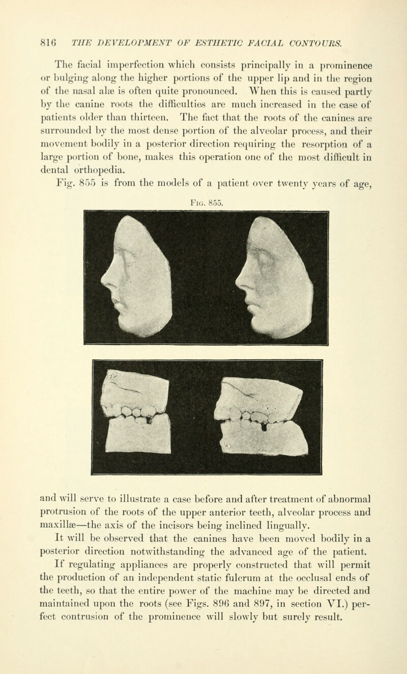 The facial imperfection which consists principally in a prominence or bulging along the higher portions of the upper lip and in the region of the na.sal alie is often quite pronounced. When this is caused partly by the canine roots the difficulties are much increased in the case of patients older than thirteen. The fact that the roots of the canines are surrounded by the most dense i)ortion of the alveolar process, and their movement bodily in a posterior direction requiring the resorption of a large portion of bone, makes this operation one of the most difficult in dental orthopedia. Fig. 855 is from the models of a patient over twenty years of age, Fk;. 855. and will serve to illustrate a case before and after treatment of abnormal protrusion of the roots of the upper anterior teeth, alveolar process and maxillae—the axis of the incisors being inclined lingually. It will be observed that the canines have been moved bodily in a posterior direction notwithstanding the advanced age of the patient. If regulating appliances are properly constructed that will permit the production of an independent static fulcrum at the occlusal ends of the teeth, so that the entire power of the machine may be directed and maintained upon the roots (see Figs. 896 and 897, in section VI.) per- fect contrusion of the prominence will slowly but surely result.