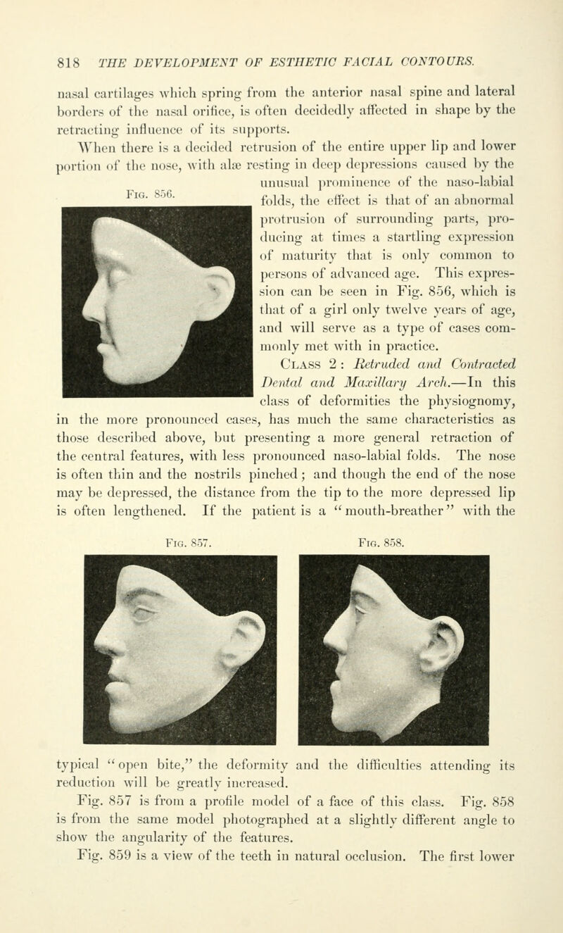 Fig. S5G. nasal cartilages which spring from the anterior nasal spine and lateral borders of tlie nasal orifice, is often decidedly affected in shape by the retracting influence of its supports. When there is a decided retrusion of the entire upper lip and lower portion of the nose, with ahe resting in deep depressions caused by the unusual j^rominence of the naso-labial folds, the effect is that of an abnormal protrusion of surrounding parts, pro- (hieing at times a startling expression of maturity that is only common to persons of advanced age. This expres- sion can be seen in Fig. 856, which is that of a girl only twelve years of age, and will serve as a type of cases com- monly met with in practice. Class 2 : Retruded and Contracted Dental and Maxillary Arch.—In this class of deformities the physiognomy, in the more pronounced cases, has much the same characteristics as those described above, but presenting a more general retraction of the central features, with less pronounced naso-labial folds. The nose is often thin and the nostrils pinched ; and though the end of the nose may be depressed, the distance from the tip to the more depressed lip is often lengthened. If the patient is a mouth-breather with the Fig. 857. Fig. 858. typical  open bite, the deformity and the difficulties attending its reduction will be greatly increased. Fig. 857 is from a profile model of a face of this class. Fig. 858 is from the same model photographed at a slightly different angle to show the angularity of tlie features. Fig. 859 is a view of the teeth in natural occlusion. The first lower