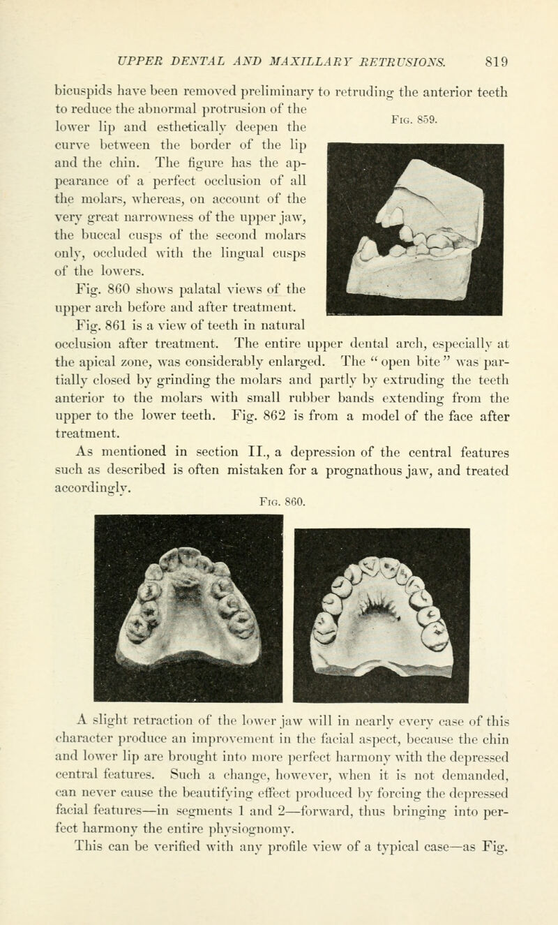 Fig. 859. bicuspids have been removed preliminary to retruding the anterior teeth to reduce the abnormal protrusion of the loAver lip and esthetically deepen the curve between the border of the lip and the chin. The figure has the ap- pearance of a perfect occlusion of all the molars, whereas, on account of the very' great narrowness of the upper jaw, the buccal cusps of the second molars only, occluded with the lingual cusps of the lowers. Fig. 860 shows palatal views of the upper arch before and after treatment. Fig. 861 is a view of teeth in natural occlusion after treatment. The entire upper dental arch, especially at the apical zone, was considerably enlarged. The  open bite  was par- tially closed by grinding the molars and partly by extruding the teeth anterior to the molars with small rubber bands extending from the upper to the lower teeth. Fig. 862 is from a model of the face after treatment. As mentioned in section II., a depression of the central features such as described is often mistaken for a prognathous jaw, and treated accordiuijlv. Fig. 860. A slight retraction of the lower jaw will in nearly every case of this character produce an improvement in the facial aspect, because the chin and lower lip are brought into more perfect harmony with the depressed central features. Such a eliange, however, when it is not demanded, can never cause the beautifying eifect produced by forcing the depressed facial features—in segments 1 and 2—forward, thus bringing into per- fect harmony the entire jihysiognomy. This can be verified with any profile view of a typical case—as Fig.