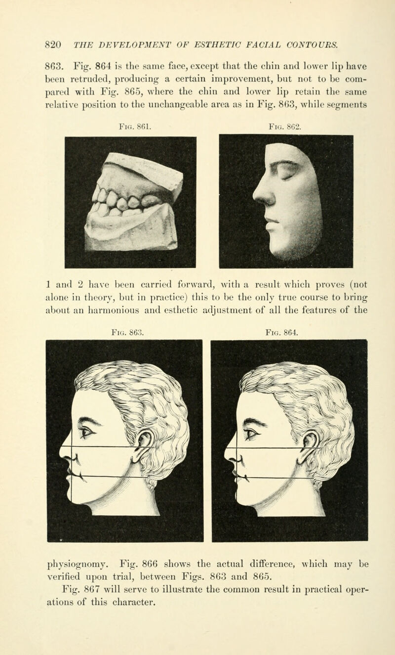 863. Fig. 864 is the same face, except that the chin and h)\ver lip have been retruded, producing a certain improvement, but not to be com- pared with Fig. 865, where the chin and lower lip retain the same relative position to the unchangeable area as in Fig. 863, while segments Fig. 8(;1. Fk;. 8G2. 1 and 2 have been carried forward, with a result which proves (not alone in theory, but in practice) this to be the only true course to bring about an harmonious and esthetic adjustment of all the features of the Fig. 863. Fig. 864. physiognomy. Fig. 866 shows the actual difference, which may be verified upon trial, between Figs. 863 and 865. Fig. 867 will serve to illustrate the common result in practical oper- ations of this character.