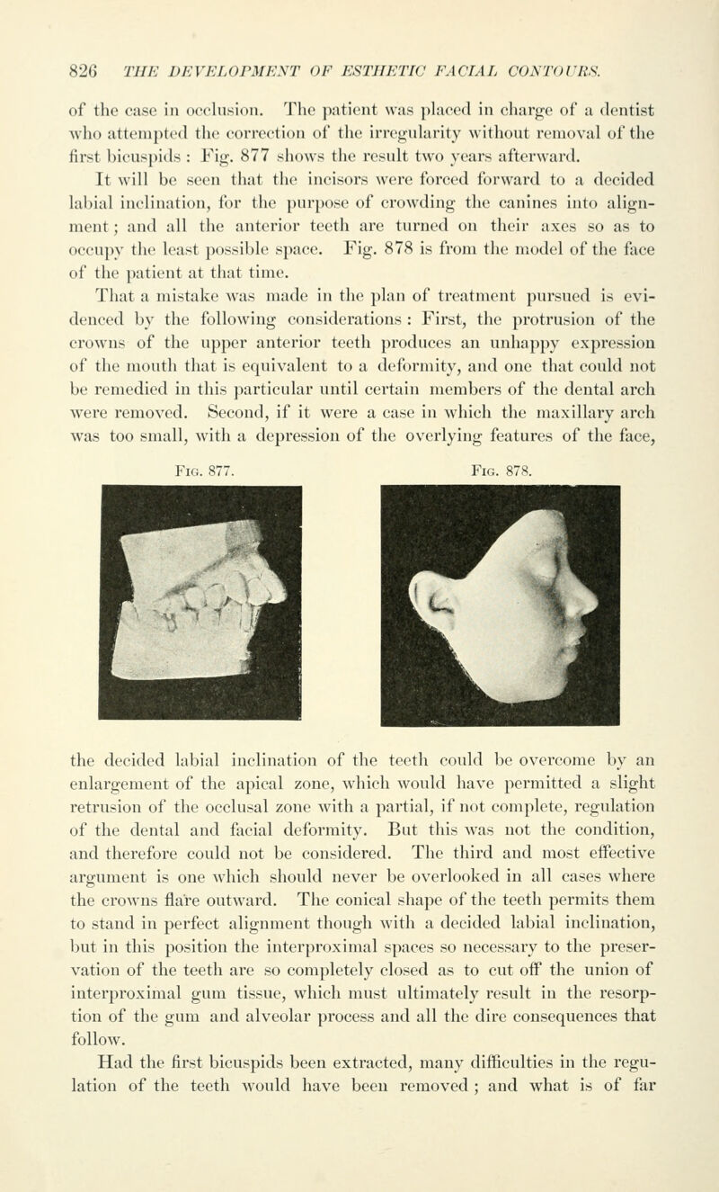 of the case in occlusion. The patient was placed in charge of a dentist Avho attempted the correction of the irregularity without removal of the first bicus})ids : Fig. 877 shows the result two years afterward. It will be seen that the incisors were forced forward to a decided labial inclination, for the purpose of crowding the canines into align- ment ; and all the anterior teeth are turned on their axes so as to occupy the least possible space. Fig. 878 is from the model of the face of the patient at that time. That a mistake was made in the plan of treatment pursued is evi- denced by the following considerations : First, the protrusion of the crowns of the upper anterior teeth produces an unhappy expression of the mouth that is equivalent to a deformity, and one that could not be remedied in this particular until certain members of the dental arch were removed. Second, if it were a case in which the maxillary arch Avas too small, with a depression of the overlying features of the face, Fig. 877. Fig. 87S. the decided labial inclination of the teeth could be overcome by an enlargement of the apical zone, which would have permitted a slight retrusion of the occlusal zone with a partial, if not complete, regulation of the dental and facial deformity. But this was not the condition, and therefore could not be considered. The third and most effective argument is one which should never be overlooked in all cases where the crowns flare outward. The conical shape of the teeth permits them to stand in perfect alignment though with a decided labial inclination, but in this position the interproximal spaces so necessary to the preser- vation of the teeth are so completely closed as to cut off the union of interproximal gum tissue, which must ultimately result in the resorp- tion of the gum and alveolar process and all the dire consequences that follow. Had the first bicuspids been extracted, many difficulties in the regu- lation of the teeth would have been removed ; and what is of far