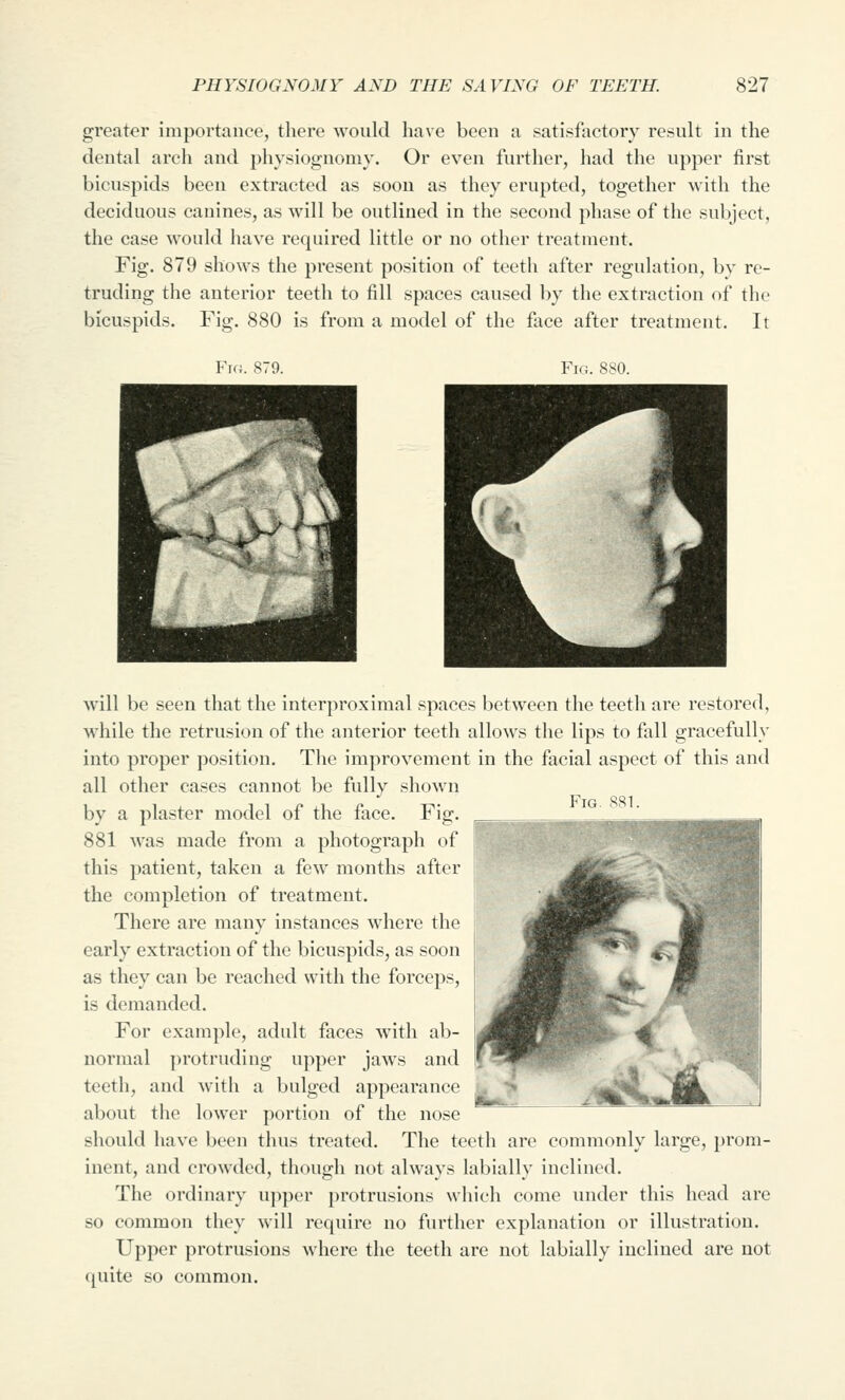 greater importance, there Avould have been a satisfactory result in the dental arch and physiognomy. Or even further, had the upper first bicuspids been extracted as soon as they erupted, together with the deciduous canines, as will be outlined in the second phase of the subject, the case would have required little or no other treatment. Fig. 879 shows the present position of teeth after regulation, by re- truding the anterior teeth to fill spaces caused by the extraction of the bicuspids. Fig. 880 is from a model of the face after treatment. It Fig. 881. will be seen that the interproximal spaces between the teeth are restored, while the retrusion of the anterior teeth allows the lips to fall gracefully into proper position. The improvement in the facial aspect of this and all other cases cannot be fully shown by a plaster model of the face. Fig. 881 was made from a photograph of this patient, taken a few months after the completion of treatment. There are many instances where the early extraction of the bicuspids, as soon as they can be reached with the forceps, is demanded. For example, adult faces with ab- normal protruding upper jaws and teeth, and with a bulged appearance about the lower portion of the nose should have been thus treated. The teeth are commonly large, prom- inent, and crowded, though not always labially inclined. The ordinary upper protrusions which come under this head are so common they will require no further explanation or illustration. Upper protrusions where the teeth are not labially iucliued are not quite so common. lfe»^