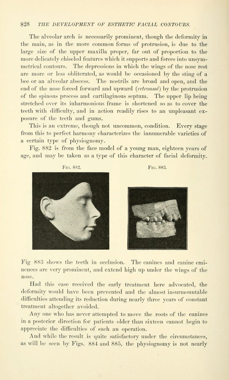The alveolar arch is necessarily prominent, though the deformity in the main, as in the more common iorms of ])rotrusion, is due to the large size of the upper maxilla proper, far out of proportion to the more delicately chiseled features which it sup})orts and forces into unsym- metrical contours. The depressions in which the wings of the nose rest are more or less obliterated, as would be occasioned by the sting of a bee or an alveolar abscess. The nostrils are broad and open, and the end of the nose forced forward and upward (retrousse) by the protrusion of the spinous process and cartilaginous septum. The upper lip being- stretched over its inharmonious frame is shortened so as to cover the teeth with difficulty, and in action readily rises to an unpleasant ex- posure of the teeth and gums. This is an extreme, though not uncommon, condition. Every stage from this to perfect harmony characterizes the innumerable varieties of a certain type of physiognomy. Fig. 882 is from the face model of a young man, eighteen years of age, and may be taken as a type of this character of facial deformity. Fig. 882. Fig. 883. Fig 883 shows the teeth in occlusion. The canines and canine emi- nences are very prominent, and extend high up under the wings of the nose. Had this case received the early treatment here advocated, the deformity would have been prevented and the almost insurmountable difficulties attending its reduction during nearly three years of constant treatment altogether avoided. Any one who has never attempted to move the roots of the canines in a posterior direction for patients older than sixteen cannot begin to appreciate the difficulties of such an operation. And while the result is quite satisfactory under the circumstances, as will be seen by Figs. 884 and 885, the physiognomy is not nearly