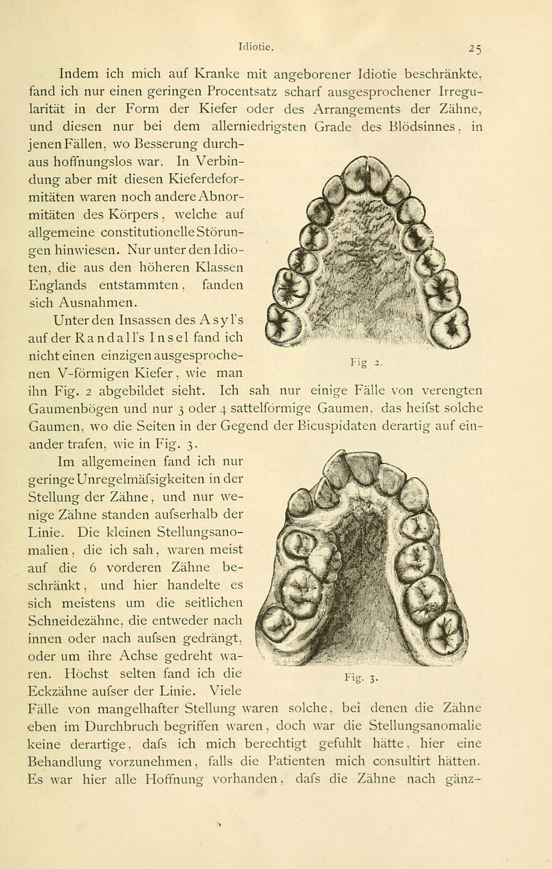 Fis Indem ich mich auf Kranke mit angeborener Idiotie beschränkte, fand ich nur einen geringen Procentsatz scharf ausgesprochener Irregu- larität in der Form der Kiefer oder des Arrangements der Zähne, und diesen nur bei dem allerniedrigsten Grade des Blödsinnes. in jenen Fällen, wo Besserung durch- aus hoffnungslos war. In Verbin- dung aber mit diesen Kieferdefor- mitäten waren noch andere Abnor- mitäten des Körpers , welche auf allgemeine constitutionelle Störun- gen hinwiesen. Nur unter den Idio- ten, die aus den höheren Klassen Englands entstammten, fanden sich Ausnahmen. Unter den Insassen des Asyl's auf der RandalFs Insel fand ich nicht einen einzigen ausgesproche- nen V-förmigen Kiefer , wie man ihn Fig. 2 abgebildet sieht. Ich sah nur einige Fälle von verengten Gaumenbögen und nur 3 oder 4 sattelförmige Gaumen, das heifst solche Gaumen, wo die Seiten in der Gegend der Bicuspidaten derartig auf ein- ander trafen, wie in Fig. 3. Im allgemeinen fand ich nur geringe Unregelmäfsigkeiten in der Stellung der Zähne, und nur we- nige Zähne standen aufserhalb der Linie. Die kleinen Stellungsano- malien , die ich sah, waren meist auf die 6 vorderen Zähne be- schränkt , und hier handelte es sich meistens um die seitlichen Schneidezähne, die entweder nach innen oder nach aufsen gedrängt, oder um ihre Achse gedreht wa- ren. Höchst selten fand ich die Eckzähne aufser der Linie. Viele Fälle von mangelhafter Stellung waren solche, bei denen die Zähne eben im Durchbruch begriffen waren, doch war die Stellungsanomalie keine derartige, dafs ich mich berechtigt gefühlt hätte. hier eine Behandlung vorzunehmen, falls die Patienten mich consultirt hätten. Es war hier alle Hoffnung vorhanden. dafs die Zähne nach gänz- Fig. 3.