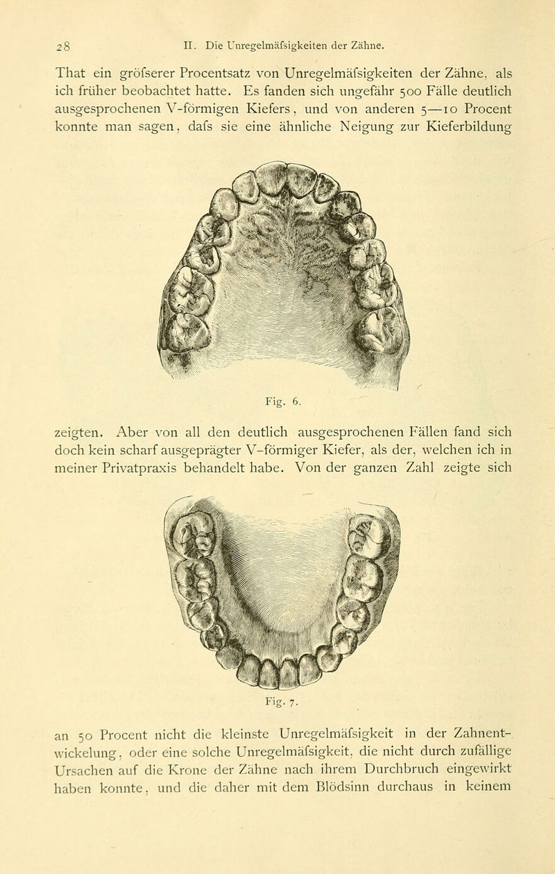 That ein gröfserer Procentsatz von Unregelmäfsigkeiten der Zähne, als ich früher beobachtet hatte. Es fanden sich ungefähr 500 Fälle deutlich ausgesprochenen V-förmigen Kiefers, und von anderen 5—10 Procent konnte man sagen, dafs sie eine ähnHche Neisfuno- zur Kieferbilduncr Fig. 6. zeigten. Aber von all den deutlich ausgesprochenen Fällen fand sich doch kein scharf ausgeprägter V-förmiger Kiefer, als der, welchen ich in meiner Privatpraxis behandelt habe. Von der ganzen Zahl zeigte sich Fig. 7. an 50 Procent nicht die kleinste Unrcgelmäfsigkeit in der Zahnent- wickelung . oder eine solche Unrcgelmäfsigkeit, die nicht durch zufällige Ursachen auf die Krone der Zähne nach ihrem Durchbruch eingewirkt haben konnte, und die daher mit dem Blödsinn durchaus in keinem