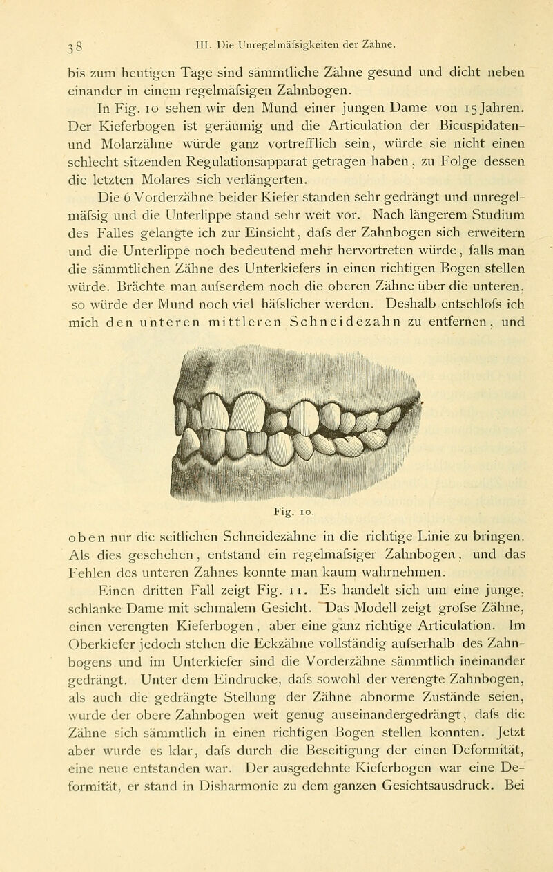bis zum heutigen Tage sind sämmtliche Zähne gesund und dicht neben einander in einem regelmäfsigen Zahnbogen. In Fig. lo sehen wir den Mund einer jungen Dame von 15 Jahren. Der Kieferbogen ist geräumig und die Articulation der Bicuspidaten- und Molarzähne würde ganz vortreffHch sein, würde sie nicht einen schlecht sitzenden Regulationsapparat getragen haben, zu Folge dessen die letzten Molares sich verlängerten. Die 6 Vorderzähne beider Kiefer standen sehr gedrängt und unregel- mäfsig und die Unterlippe stand sehr weit vor. Nach längerem Studium des Falles gelangte ich zur Einsicht, dafs der Zahnbogen sich erweitern und die Unterlippe noch bedeutend mehr hervortreten würde, falls man die sämmtlichen Zähne des Unterkiefers in einen richtigen Bogen stellen würde. Brächte man aufserdem noch die oberen Zähne über die unteren, so würde der Mund noch viel häfslicher werden. Deshalb entschlofs ich mich den unteren mittleren Schneidezahn zu entfernen, und Fig. 10. oben nur die seitlichen Schneidezähne in die richtige Linie zu bringen. Als dies geschehen, entstand ein regelmäfsiger Zahnbogen, und das Fehlen des unteren Zahnes konnte man kaum wahrnehmen. Einen dritten Fall zeigt Fig. 11. Es handelt sich um eine junge, schlanke Dame mit schmalem Gesicht. Das Modell zeigt grofse Zähne, einen verengten Kieferbogen , aber eine ganz richtige Articulation. Im Oberkiefer jedoch stehen die Eckzähne vollständig aufserhalb des Zahn- bogens und im Unterkiefer sind die Vorderzähne sämmtlich ineinander gedrängt. Unter dem Eindrucke, dafs sowohl der verengte Zahnbogen, als auch die gedrängte Stellung der Zähne abnorme Zustände seien, wurde der obere Zahnbogen weit genug auseinandergedrängt, dafs die Zähne sich sämmtlich in einen richtigen Bogen stellen konnten. Jetzt aber wurde es klar, dafs durch die Beseitigung der einen Deformität, eine neue entstanden war. Der ausgedehnte Kieferbogen war eine De- formität, er stand in Di.sharmonie zu dem ganzen Gesichtsausdruck. Bei