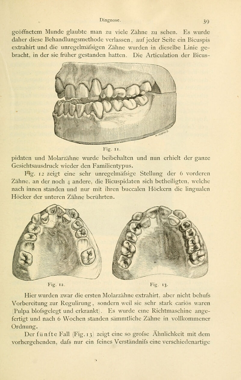 geöffnetem Munde glaubte man zu viele Zähne zu sehen. Es wurde daher diese Behandlungsmethode verlassen, auf jeder Seite ein Bicuspis e.xtrahirt und die unregelmäfsigen Zähne wurden in dieselbe Linie ge- bracht, in der sie früher gestanden hatten. Die Articulation der Bicus- Fig. II. pidaten und Molarzähne wurde beibehalten und nun erhielt der ganze Gesichtsausdruck wieder den Familientypus. Fig. 12 zeigt eine sehr unregelmäfsige Stellung der 6 vorderen Zähne, an der noch 4 andere, die Bicuspidaten sich betheiligten, welche nach innen standen und nur mit ihren buccalen Höckern die lingualen Höcker der unteren Zähne berührten. Fig. 12. Fig. 13- Hier wurden zwar die ersten Molarzähne extrahirt, aber nicht behufs Vorbereitung zur Regulirung, sondern weil sie sehr stark cariös waren (Pulpa blofsgelegt und erkrankt). Es wurde enie Richtmaschine ange- fertigt und nach 6 Wochen standen sämmtliche Zähne in vollkommener Ordnung. Der fünfte Fall (Fig. 13) zeigt eine so grofse Ähnlichkeit mit dem vorhergehenden, dafs nur ein feines Verständnifs eine verschiedenartige