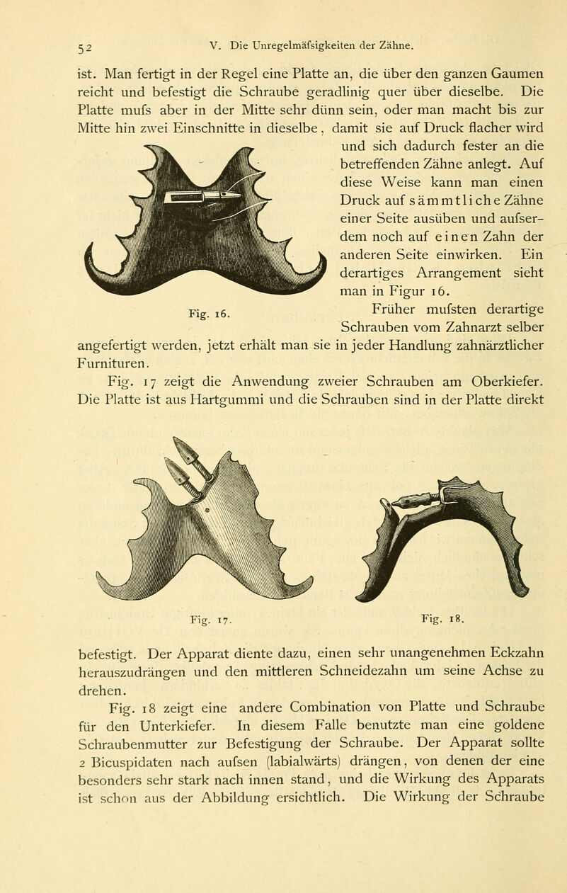 ist. Man fertigt in der Regel eine Platte an, die über den ganzen Gaumen reicht und befestigt die Schraube geradlinig quer über dieselbe. Die Platte mufs aber in der Mitte sehr dünn sein, oder man macht bis zur Mitte hin zwei Einschnitte in dieselbe, damit sie auf Druck flacher wird und sich dadurch fester an die betreffenden Zähne anlegt. Auf diese Weise kann man einen Druck auf s ä m m 11 i ch e Zähne einer Seite ausüben und aufser- dem noch auf einen Zahn der inderen Seite einwirken. Ein lerartiges Arrangement sieht man in Figur i6. Früher mufsten derartige Schrauben vom Zahnarzt selber angefertigt werden, jetzt erhält man sie in jeder Handlung zahnärztlicher Furnituren. Fig. 17 zeigt die Anwendung zweier Schrauben am Oberkiefer. Die Platte ist aus Hartgummi und die Schrauben sind in der Platte direkt Fig. i6. \ Fig. 17. Fig. 18. befestigt. Der Apparat diente dazu, einen sehr unangenehmen Eckzahn herauszudrängen und den mittleren Schneidezahn um seine Achse zu drehen. Fig. 18 zeigt eine andere Combination von Platte und Schraube für den Unterkiefer. In diesem Falle benutzte man eine goldene Schraubenmutter zur Befestigung der Schraube. Der Apparat sollte 2 Bicuspidaten nach aufsen (labialwärts) drängen, von denen der eine besonders sehr stark nach innen stand, und die Wirkung des Apparats i.st schon aus der Abbildung ersichtlich. Die Wirkung der Schraube