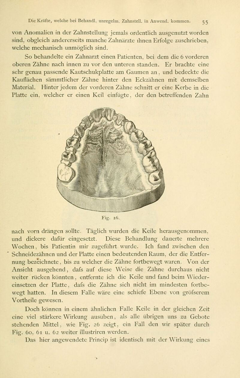 :>:> von Anomalien in der Zahnstellung jemals ordentlich ausgenutzt worden sind, obgleich andererseits manche Zahnärzte ihnen Erfolge zuschrieben, welche mechanisch unmöglich sind. So behandelte ein Zahnarzt einen Patienten, bei dem die 6 vorderen oberen Zähne nach innen zu vor den unteren standen. Er brachte eine sehr genau passende Kautschukplatte am Gaumen an, und bedeckte die Kauflächen sämmtlicher Zähne hinter den Eckzähnen mit demselben Material. Hinter jedem der vorderen Zähne schnitt er eine Kerbe in die Platte ein, welcher er einen Keil einfügte. der den betreffenden Zahn ifSft^. Fig. 26. nach vorn drängen sollte. Täglich wurden die Keile herausgenommen, und dickere dafür eingesetzt. Diese Behandlung dauerte mehrere Wochen, bis Patientin mir zugeführt wurde. Ich fand zwischen den Schneidezähnen und der Platte einen bedeutenden Raum, der die Entfer- nung bezeichnete, bis zu welcher die Zähne fortbewegt waren. Von der Ansicht ausgehend, dafs auf diese Weise die Zähne durchaus nicht weiter rücken könnten, entfernte ich die Keile und fand beim Wieder- einsetzen der Platte, dafs die Zähne sich nicht im mindesten fortbe- wegt hatten. In diesem Falle wäre eine schiefe Ebene von gröfserem Vortheile gewesen. Doch können in einem ähnlichen Falle Keile in der gleichen Zeit eine viel stärkere Wirkung ausüben, als alle übrigen uns zu Gebote stehenden Mittel, wie Fig. 26 zeigt, ein Fall den wir später durch Fig. 60, 61 u. 62 weiter illustriren werden. Das hier angewendete Princip ist identisch mit der \\'irkung eines