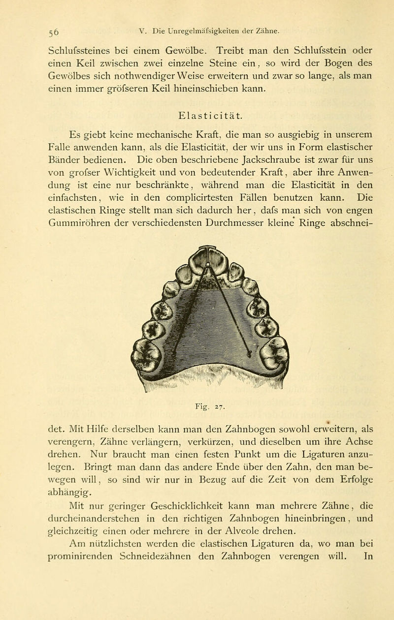 Schlufssteines bei einem Gewölbe. Treibt man den Schlufsstein oder einen Keil zwischen zwei einzelne Steine ein, so wird der Bogen des Gewölbes sich nothwendiger Weise erweitern und zwar so lange, als man einen immer gröfseren Keil hineinschieben kann. Elasti cität. Es giebt keine mechanische Kraft, die man so ausgiebig in unserem Falle anwenden kann, als die Elasticität, der wir uns in Form elastischer Bänder bedienen. Die oben beschriebene Jackschraube ist zwar für uns von grofser Wichtigkeit und von bedeutender Kraft, aber ihre Anwen- dung ist eine nur beschränkte, während man die Elasticität in den einfachsten, wie in den complicirtesten Fällen benutzen kann. Die elastischen Ringe stellt man sich dadurch her, dafs man sich von engen Gummiröhren der verschiedensten Durchmesser kleine Ringe abschnei- Fig. 27. « det. Mit Hilfe derselben kann man den Zahnbogen sowohl erweitern, als verengern, Zähne verlängern, verkürzen, und dieselben um ihre Achse drehen. Nur braucht man einen festen Punkt um die Ligaturen anzu- legen. Bringt man dann das andere Ende über den Zahn, den man be- wegen will, so sind wir nur in Bezug auf die Zeit von dem Erfolge abhängig. Mit nur geringer Geschicklichkeit kann man mehrere Zähne, die durcheinanderstehen in den richtigen Zahnbogen hineinbringen, und gleichzeitig einen oder mehrere in der Alveole drehen. Am nützlichsten werden die elastischen Ligaturen da, wo man bei prominirenden Schneidezähnen den Zahnbogen verengen will. In