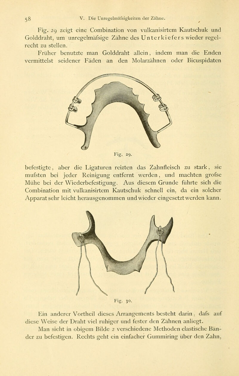 Fig. 29 zeigt eine Combination von vulkanisirtem Kautschuk und Golddraht, um unregelmäfsige Zähne des Unterkiefers wieder regel- recht zu stellen. Früher benutzte man Golddraht allein, indem man die Enden vermittelst seidener Fäden an den Molarzähnen oder Bicuspidaten Fig. 29. befestigte, aber die Ligaturen reizten das Zahnfleisch zu stark, sie mufsten bei jeder Reinigung entfernt werden, und machten grofse Mühe bei der Wiederbefestigung. Aus diesem Grunde führte sich die Combination mit vulkanisirtem Kautschuk schnell ein, da ein solcher Apparat sehr leicht herausgenommen und wieder eingesetzt werden kann. Fig. 30. Ein anderer Vortheil dieses Arrangements besteht darin. dafs auf diese Wei.se der Draht viel ruhiger und fester den Zähnen anliegt. Man sieht in obigem Bilde 2 verschiedene Methoden elastische Bän- der zu befestigen. Rechts geht ein einfacher Gummiring über den Zahn,
