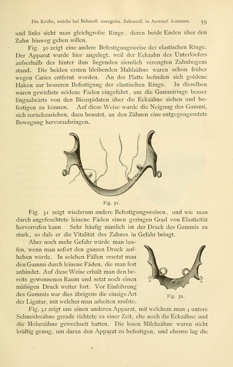 und links sieht man gleichgrofse Ringe. deren beide Enden über den Zahn hinweg gehen sollen. Fig. 30 zeigt eine andere Befestigungsweise der elastischen Ringe. Der Apparat wurde hier angelegt, weil der Eckzahn des Unterkiefers aufserhalb des hinter ihm liegenden ziemlich verengten Zahnbogens stand. Die beiden ersten bleibenden Mahlzähne waren schon früher wegen Caries entfernt worden. An der Platte befinden sich goldene Haken zur besseren Befestigung der elastischen Ringe. In dieselben waren gewichste seidene Fäden eingeführt, um die Gummiringe besser lingualwärts von den Bicuspidaten über die Eckzähne ziehen und be- festigen zu können. Auf diese Weise wurde die Neigung des Gummi, sich zurückzuziehen, dazu benutzt, an den Zähnen eine entgegengesetzte Bewegung hervorzubringen. Fig- 31- Fig. 31 zeigt wiederum andere Befestigungsweisen, und wie man durch angefeuchtete leinene Fäden einen geringen Grad von Elasticität hervorrufen kann. Sehr häufig nämlich ist der Druck des Gummis zu stark, so dafs er die Vitalität des Zahnes in Gefahr bringt. Aber noch mehr Gefahr würde man lau- fen, wenn man sofort den ganzen Druck auf- heben würde. In solchen Fällen ersetzt man den Gummi durch leinene Fäden, die man fest anbindet. Auf diese Weise erhält man den be- reits gewonnenen Raum und setzt noch einen mäfsigen Druck weiter fort. Vor Einführung des Gummis war dies übrigens die einzige Art der Ligatur, mit welcher man arbeiten mufste. Fig. 32 zeigt uns einen anderen Apparat, mit welchem man 4 untere Schneidezähne gerade richtete zu einer Zeit, ehe noch die Eckzähne und die Molarzähne gewechselt hatten. Die losen Milchzähne waren nicht kräftig genug, um daran den Apparat zu befestigen, und ebenso lag die Fig- 32.