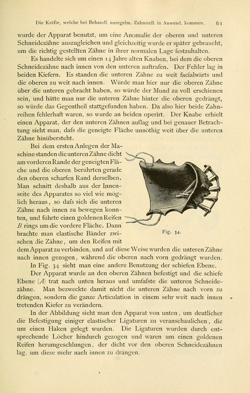 wurde der Apparat benutzt, um eine Anomalie der oberen und unteren Schneidezähne auszugleichen und gleichzeitig wurde er später gebraucht, um die richtig gestellten Zähne in ihrer normalen Lage festzuhalten. Es handelte sich um einen 14 Jahre alten Knaben, bei dem die oberen Schneidezähne nach innen von den unteren auftrafen. Der Fehler lag in beiden Kiefern. Es standen die unteren Zähne zu weit facialwärts und die oberen zu weit nach innen. Würde man hier nur die oberen Zähne über die unteren gebracht haben, so würde der Mund zu voll erschienen sein, und hätte man nur die unteren Zähne hinter die oberen gedrängt, so würde das Gegentheil stattgefunden haben. Da also hier beide Zahn- reihen fehlerhaft waren, so wurde an beiden operirt. Der Knabe erhielt einen Apparat, der den unteren Zähnen auflag und bei genauer Betrach- tung sieht man, dafs die geneigte Fläche unnöthig weit über die unteren Zähne hinübersteht. Bei dem ersten Anlegen der Ma- schine standen die unteren Zähne dicht am vorderen Rande der geneigten Flä- che und die oberen berührten gerade den oberen scharfen Rand derselben. Man schnitt deshalb aus der Innen- seite des Apparates so viel wie mög- lich heraus, so dafs sich die unteren Zähne nach innen zu bewegen konn- ten, und führte einen goldenen Reifen B rings um die vordere Fläche. Dann brachte man elastische Bänder zwi- ^'S- 34- sehen die Zähne, um den Reifen mit dem Apparat zu verbinden, und auf diese Weise wurden die unteren Zähne nach innen gezogen, während die oberen nach vorn gedrängt wurden. In Fig. 34 sieht man eine andere Benutzung der schiefen Ebene. Der Apparat wurde an den oberen Zähnen befestigt und die schiefe Ebene [Ä\^ trat nach unten heraus und umfafste die unteren Schneide- zähne. Man bezweckte damit nicht die unteren Zähne nach vorn zu drängen, sondern die ganze Articulation in einem sehr weit nach innen tretenden Kiefer zu verändern. In der Abbildung sieht man den Apparat von unten, um deutlicher die Befestigung einiger elastischer Ligaturen zu veranschaulichen, die um einen Haken gelegt wurden. Die Ligaturen wurden durch ent- sprechende Löcher hindurch gezogen und waren um einen goldenen Reifen herumgeschlungen, der dicht vor den oberen Schneidezähnen laer. um diese mehr nach innen zu drängen.