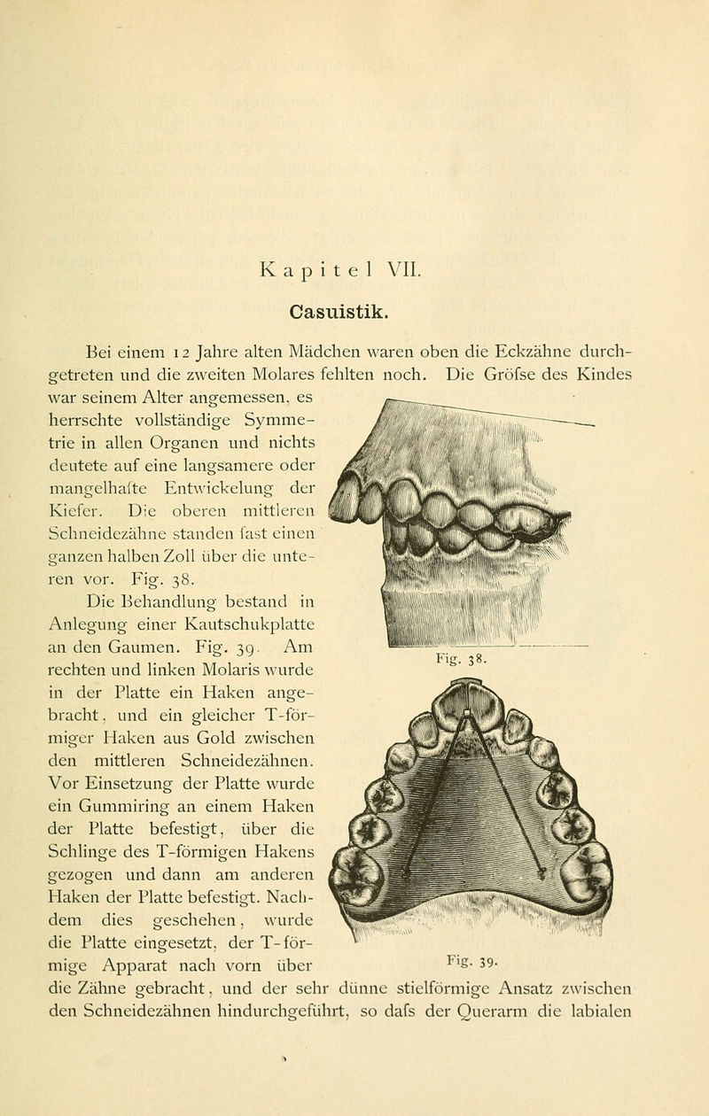 Casuistik. Bei einem 12 Jahre alten Mädchen waren oben die Eckzähne durch- getreten und die zweiten Molares fehlten noch. Die Gröfse des Kindes war seinem Alter angemessen, es herrschte vollständige Symme- trie in allen Organen und nichts deutete auf eine langsamere oder mangelhafte Entwickelung der Kiefer. Die oberen mittleren Schneidezähne standen fast einen ganzen halben Zoll über die unte- ren vor. Fig. 38. Die Behandlung bestand in Anlegung einer Kautschukplatte an den Gaumen. Fig. 3g. Am rechten und linken Molaris wurde in der Platte ein Haken ange- bracht . und ein gleicher T-för- miger Haken aus Gold zwischen den mittleren Schneidezähnen. Vor Einsetzung der Platte wurde ein Gummiring an einem Haken der Platte befestigt, über die Schlinge des T-förmigen Hakens gezogen und dann am anderen Haken der Platte befestigt. Nach- dem dies geschehen, wurde die Platte eingesetzt, der T-för- mige Apparat nach vorn über Fig. 39- die Zähne gebracht, und der sehr dünne stielförmige Ansatz zwischen den Schneidezähnen hindurchgeführt, so dafs der Ouerarm die labialen