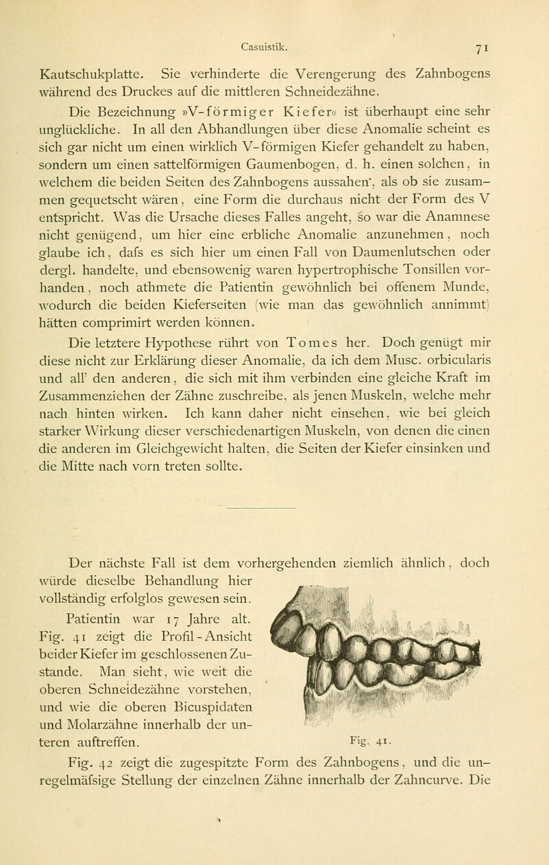 Kautschukplatte, Sie verhinderte die Verengerung des Zahnbogens während des Druckes auf die mittleren Schneidezähne. Die Bezeichnung »V-förmiger Kiefer« ist überhaupt eine sehr unglückliche. In all den Abhandlungen über diese Anomalie scheint es sich gar nicht um einen wirklich V-förmigen Kiefer gehandelt zu haben, sondern um einen sattelförmigen Gaumenbogen, d. h. einen solchen, in welchem die beiden Seiten des Zahnbogens aussahen, als ob sie zusam- men gequetscht wären, eine Form die durchaus nicht der Form des V entspricht. Was die Ursache dieses Falles angeht, so war die Anamnese nicht genügend, um hier eine erbliche Anomalie anzunehmen . noch glaube ich, dafs es sich hier um einen Fall von Daumenlutschen oder dergl. handelte, und ebensowenig waren hypertrophische Tonsillen vor- handen , noch athmete die Patientin gewöhnlich bei offenem Munde, wodurch die beiden Kieferseiten (wie man das gewöhnlich annimmt] hätten comprimirt werden können. Die letztere Hypothese rührt von Tomes her. Doch genügt mir diese nicht zur Erklärung dieser Anomalie, da ich dem Muse, orbicularis und all' den anderen, die sich mit ihm verbinden eine gleiche Kraft im Zusammenziehen der Zähne zuschreibe, als jenen Muskeln, welche mehr nach hinten wirken. Ich kann daher nicht einsehen, wie bei gleich starker Wirkung dieser verschiedenartigen Muskeln, von denen die einen die anderen im Gleichgewicht halten, die Seiten der Kiefer einsinken und die Mitte nach vorn treten sollte. Der nächste Fall ist dem vorhergehenden ziemlich ähnlich. doch würde dieselbe Behandlung hier vollständig erfolglos gewesen sein. Patientin war 17 Jahre alt. Fig. 41 zeigt die Profil - Ansicht beider Kiefer im geschlossenen Zu- stande. Man sieht, wie weit die oberen Schneidezähne vorstehen, und wie die oberen Bicuspidaten und Molarzähne innerhalb der un- teren auftreffen. Fig- 4i- Fig. 42 zeigt die zugespitzte Form des Zahnbogens. und die un- reselmäfsige Stellunsr der einzelnen Zähne innerhalb der Zahncurve. Die