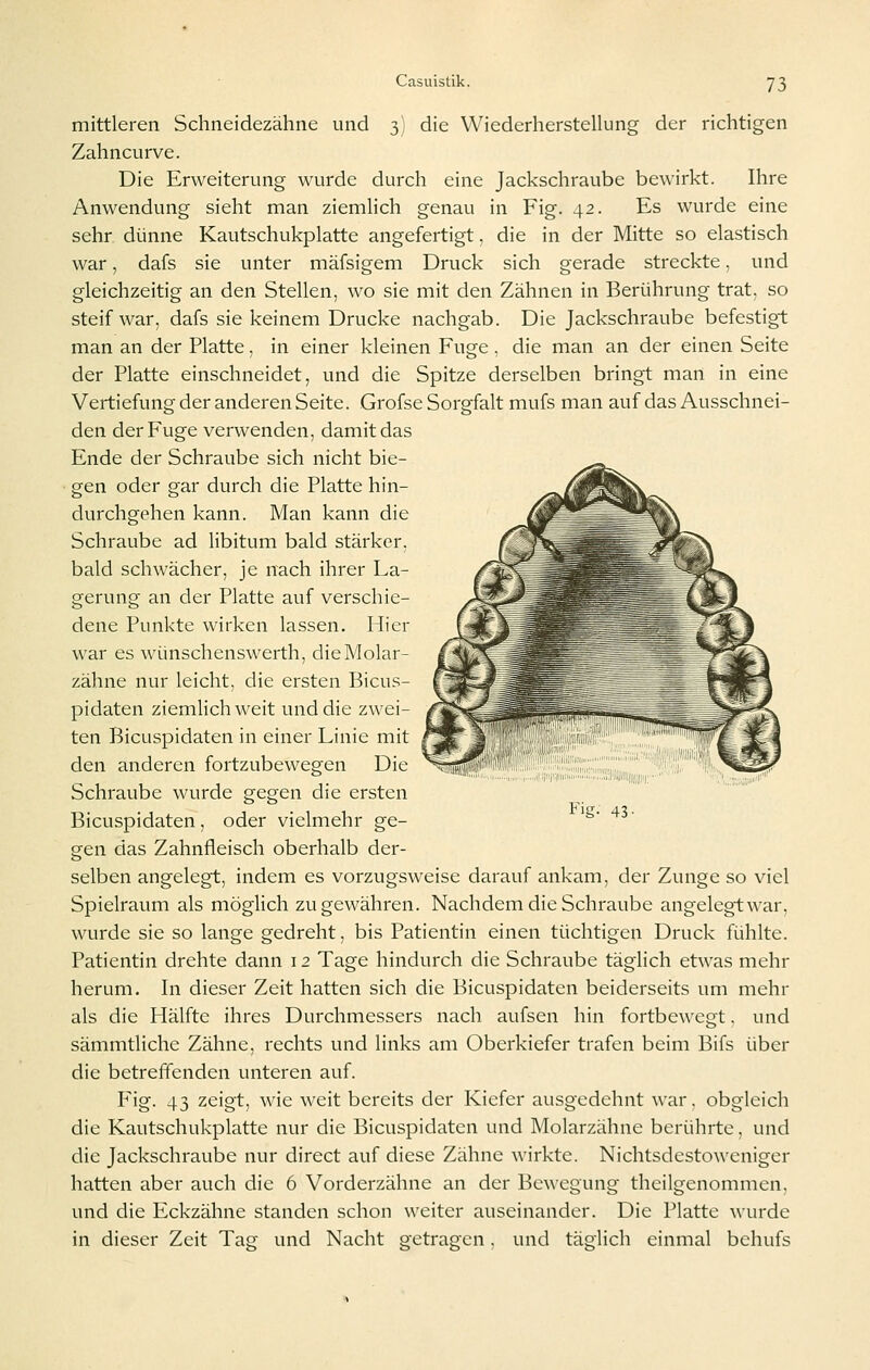 mittleren Schneidezähne und 3 die Wiederherstellung der richtigen Zahncurve. Die Erweiterung wurde durch eine Jackschraube bewirkt. Ihre Anwendung sieht man ziemlich genau in Fig. 42. Es wurde eine sehr dünne Kautschukplatte angefertigt, die in der Mitte so elastisch war, dafs sie unter mäfsigem Druck sich gerade streckte, und gleichzeitig an den Stellen, wo sie mit den Zähnen in Berührung trat, so steif war, dafs sie keinem Drucke nachgab. Die Jackschraube befestigt man an der Platte, in einer kleinen Fuge. die man an der einen Seite der Platte einschneidet, und die Spitze derselben bringt man in eine Vertiefung der anderen Seite. Grofse Sorgfalt mufs man auf das Ausschnei- den der Fuge verwenden, damit das Ende der Schraube sich nicht bie- gen oder gar durch die Platte hin- durchgehen kann. Man kann die Schraube ad libitum bald stärker, bald schwächer, je nach ihrer La- gerung an der Platte auf verschie- dene Punkte wirken lassen. Hier war es wünschenswerth, die Molar- zähne nur leicht, die ersten Bicus- pidaten ziemlich weit und die zwei- ten Bicuspidaten in einer Linie mit den anderen fortzubewegen Die Schraube wurde gegen die ersten Bicuspidaten, oder vielmehr ge- gen das Zahnfleisch oberhalb der- selben angelegt, indem es vorzugsweise darauf ankam, der Zunge so viel Spielraum als möglich zu gewähren. Nachdem die Schraube angelegt war, wurde sie so lange gedreht, bis Patientin einen tüchtigen Druck fühlte. Patientin drehte dann 12 Tage hindurch die Schraube täglich etwas mehr herum. In dieser Zeit hatten sich die Bicuspidaten beiderseits um mehr als die Hälfte ihres Durchmessers nach aufsen hin fortbewegt. und sämmtliche Zähne, rechts und links am Oberkiefer trafen beim Bifs über die betrefTenden unteren auf. Fig. 43 zeigt, wie weit bereits der Kiefer ausgedehnt war, obgleich die Kautschukplatte nur die Bicuspidaten und Molarzähne berührte, und die Jackschraube nur direct auf diese Zähne wirkte. Nichtsdestoweniger hatten aber auch die 6 Vorderzähne an der Bewegung theilgenommen. und die Eckzähne standen schon weiter auseinander. Die Platte wurde in dieser Zeit Tae und Nacht getragen, und täglich einmal behufs Fig- 43'