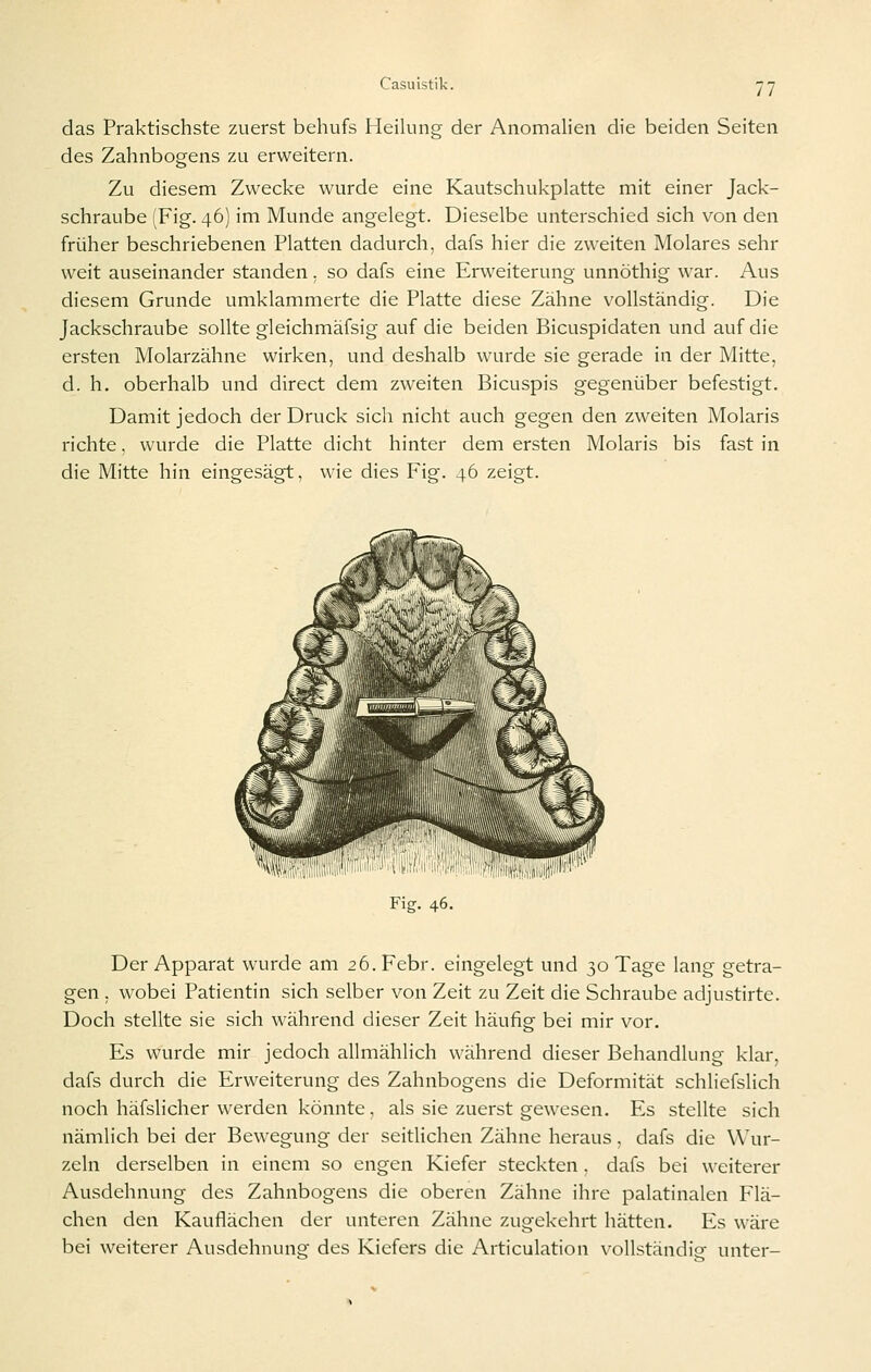 das Praktischste zuerst behufs Heilung der Anomalien die beiden Seiten des Zahnbogens zu erweitern. Zu diesem Zwecke wurde eine Kautschukplatte mit einer Jack- schraube (Fig. 46) im Munde angelegt. Dieselbe unterschied sich von den früher beschriebenen Platten dadurch, dafs hier die zweiten Molares sehr weit auseinander standen. so dafs eine Erweiterung unnöthig war. Aus diesem Grunde umklammerte die Platte diese Zähne vollständig. Die Jackschraube sollte gleichmäfsig auf die beiden Bicuspidaten und auf die ersten Molarzähne wirken, und deshalb wurde sie gerade in der Mitte, d. h. oberhalb und direct dem zweiten Bicuspis gegenüber befestigt. Damit jedoch der Druck sich nicht auch gegen den zweiten Molaris richte, wurde die Platte dicht hinter dem ersten Molaris bis fast in die Mitte hin eingesägt, wie dies Fig. 46 zeigt. Fig. 46. Der Apparat wurde am 26. Febr. eingelegt und 30 Tage lang getra- gen . wobei Patientin sich selber von Zeit zu Zeit die Schraube adjustirte. Doch stellte sie sich während dieser Zeit häufig bei mir vor. Es wurde mir jedoch allmählich während dieser Behandlung klar, dafs durch die Erweiterung des Zahnbogens die Deformität schliefslich noch häfslicher werden könnte, als sie zuerst gewesen. Es stellte sich nämlich bei der Bewegung der seitlichen Zähne heraus, dafs die Wur- zeln derselben in einem so engen Kiefer steckten . dafs bei weiterer Ausdehnung des Zahnbogens die oberen Zähne ihre palatinalen Flä- chen den Kauflächen der unteren Zähne zugekehrt hätten. Es wäre bei weiterer Ausdehnung des Kiefers die Articulation v^ollständig unter-