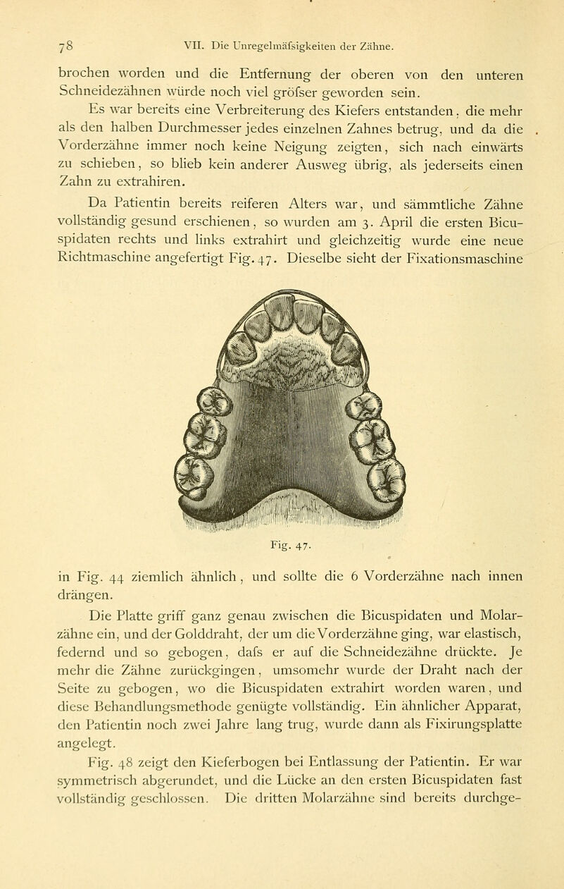 brochen worden und die Entfernung der oberen von den unteren Schneidezähnen würde noch viel gröfser geworden sein. Es war bereits eine Verbreiterung des Kiefers entstanden. die mehr als den halben Durchmesser jedes einzelnen Zahnes betrug, und da die Vorderzähne immer noch keine Neigung zeigten, sich nach einwärts zu schieben, so blieb kein anderer Ausweg übrig, als jederseits einen Zahn zu extrahiren. Da Patientin bereits reiferen Alters war, und sämmtliche Zähne vollständig gesund erschienen, so wurden am 3. April die ersten Bicu- spidaten rechts und links extrahirt und gleichzeitig wurde eine neue Richtmaschine angefertigt Fig. 47. Dieselbe sieht der Fixationsmaschine Fig. 47. in Fig. 44 ziemlich ähnlich , und sollte die 6 Vorderzähne nach innen drängen. Die Platte griff ganz genau zwischen die Bicuspidaten und Molar- zähne ein, und der Golddraht, der um die Vorderzähne ging, war elastisch, federnd und so gebogen, dafs er auf die Schneidezähne drückte. Je mehr die Zähne zurückgingen, umsomehr wurde der Draht nach der Seite zu gebogen, wo die Bicuspidaten extrahirt worden waren, und diese Behandlungsmethode genügte vollständig. Ein ähnlicher Apparat, den Patientin noch zwei Jahre lang trug, wurde dann als Fixirungsplatte angelegt. Fig. 48 zeigt den Kieferbogen bei Entlassung der Patientin. Er war symmetrisch abgerundet, und die Lücke an den ersten Bicu.spidaten fast vollständig geschlossen. Die dritten Molarzähnc sind bereits durchge-