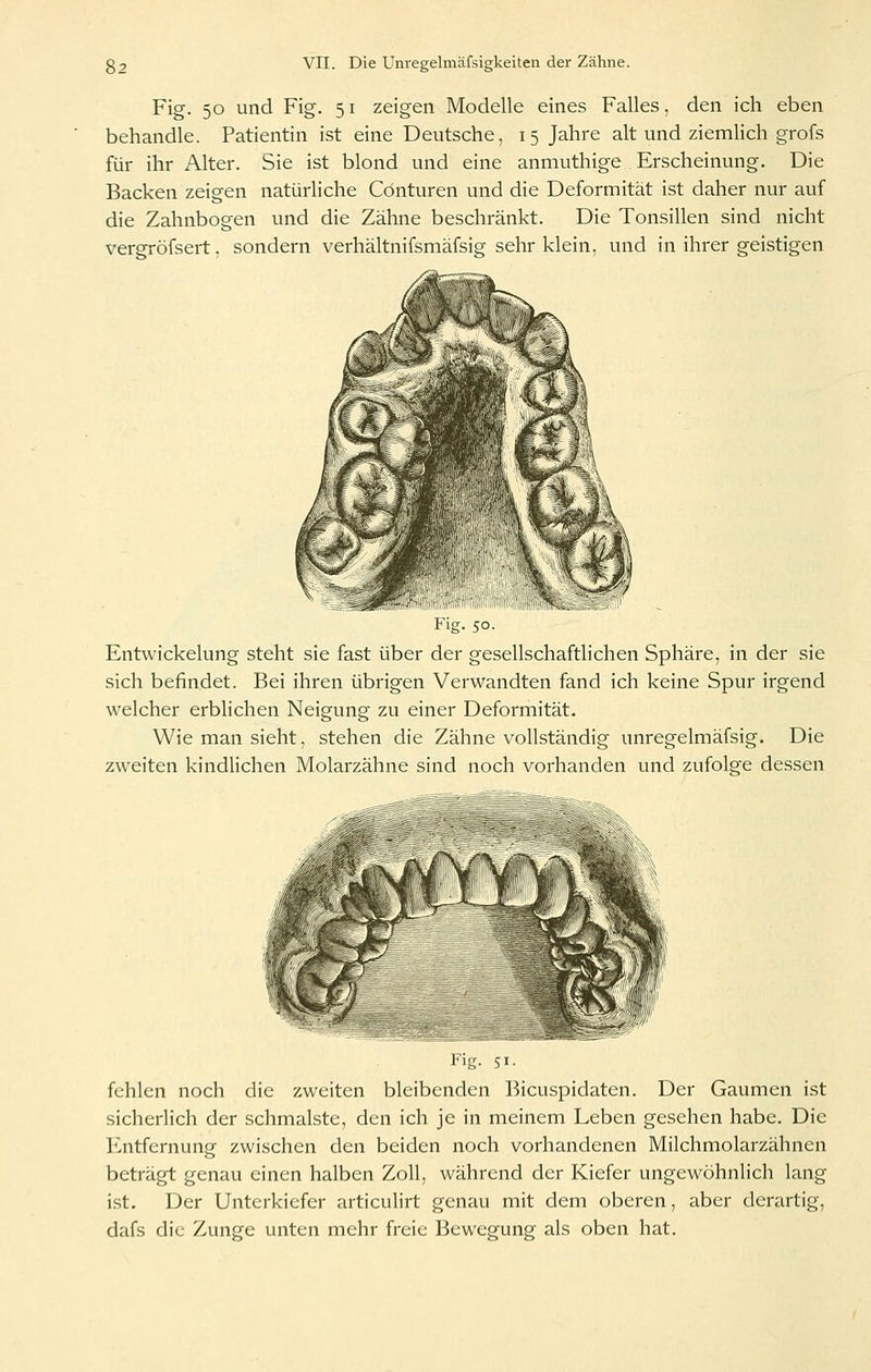 Fig. 50 und Fig. 51 zeigen Modelle eines Falles, den ich eben behandle. Patientin ist eine Deutsche, 15 Jahre alt und ziemHch grofs für ihr Alter. Sie ist blond und eine anmuthige Erscheinung. Die Backen zeigen natürliche Cönturen und die Deformität ist daher nur auf die Zahnbogen und die Zähne beschränkt. Die Tonsillen sind nicht veroTöfsert. sondern verhältnifsmäfsig sehr klein, und in ihrer geistigen Flg. 50- Entwickelung steht sie fast über der gesellschaftlichen Sphäre, in der sie sich befindet. Bei ihren übrigen Verwandten fand ich keine Spur irgend welcher erblichen Neigung zu einer Deformität. Wie man sieht, stehen die Zähne vollständig unregelmäfsig. Die zweiten kindlichen Molarzähne sind noch vorhanden und zufolge dessen Mg. 51. fehlen noch die zweiten bleibenden Bicuspidaten. Der Gaumen ist sicherlich der schmälste, den ich je in meinem Leben gesehen habe. Die Entfernung zwischen den beiden noch vorhandenen Milchmolarzähnen beträgt genau einen halben Zoll, während der Kiefer ungewöhnlich lang ist. Der Unterkiefer articulirt genau mit dem oberen, aber derartig, dafs die Zunge unten mehr freie Bewegung als oben hat.
