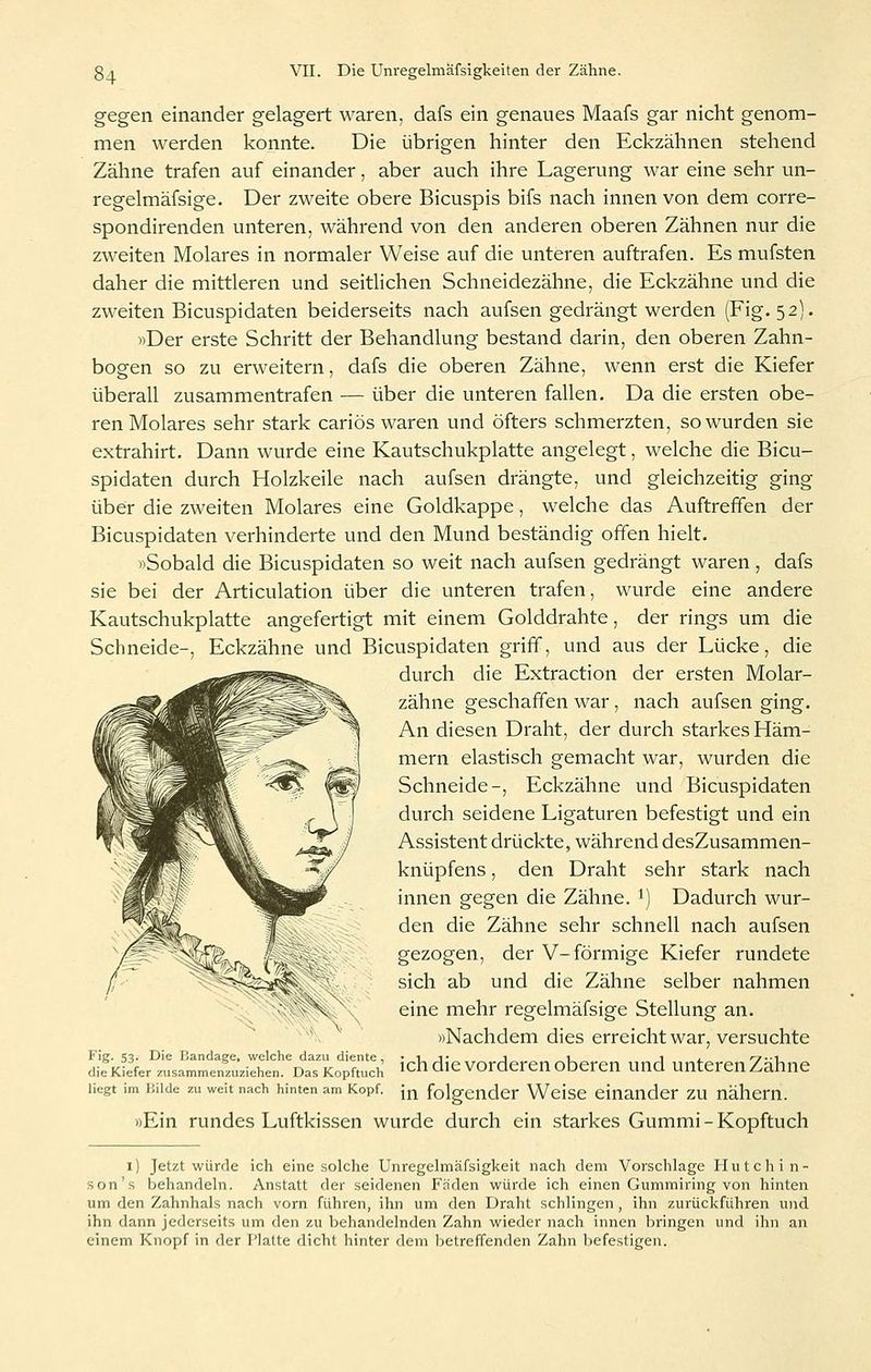 gegen einander gelagert waren, dafs ein genaues Maafs gar nicht genom- men werden konnte. Die übrigen hinter den Eckzähnen stehend Zähne trafen auf einander, aber auch ihre Lagerung war eine sehr un- regelmäfsige. Der zweite obere Bicuspis bifs nach innen von dem corre- spondirenden unteren, während von den anderen oberen Zähnen nur die zweiten Molares in normaler Weise auf die unteren auftrafen. Es mufsten daher die mittleren und seithchen Schneidezähne, die Eckzähne und die zweiten Bicuspidaten beiderseits nach aufsen gedrängt werden (Fig. 52). »Der erste Schritt der Behandlung bestand darin, den oberen Zahn- bogen so zu erweitern, dafs die oberen Zähne, wenn erst die Kiefer überall zusammentrafen — über die unteren fallen. Da die ersten obe- ren Molares sehr stark cariös waren und öfters schmerzten, so wurden sie extrahirt. Dann wurde eine Kautschukplatte angelegt, welche die Bicu- spidaten durch Holzkeile nach aufsen drängte, und gleichzeitig ging übeir die zweiten Molares eine Goldkappe, welche das Auftreffen der Bicuspidaten verhinderte und den Mund beständig offen hielt. «Sobald die Bicuspidaten so weit nach aufsen gedrängt waren , dafs sie bei der Articulation über die unteren trafen, wurde eine andere Kautschukplatte angefertigt mit einem Golddrahte, der rings um die Schneide-, Eckzähne und Bicuspidaten griff, und aus der Lücke, die durch die Extraction der ersten Molar- zähne geschaffen war , nach aufsen ging. An diesen Draht, der durch starkes Häm- mern elastisch gemacht war, wurden die Schneide-, Eckzähne und Bicuspidaten durch seidene Ligaturen befestigt und ein Assistent drückte, während desZusammen- knüpfens, den Draht sehr stark nach innen gegen die Zähne. *) Dadurch wur- den die Zähne sehr schnell nach aufsen gezogen, der V-förmige Kiefer rundete sich ab und die Zähne selber nahmen eine mehr regelmäfsige Stellung an. »Nachdem dies erreicht war, versuchte Fig. 53. Die iJandage. welche dazu diente, ,>}, fl,> vorderen oberen lind unteren Znhne die Kiefer zusammenzuziehen. Das Kopftuch '^ '^'^ VOroeren OÜCrcn UUQ UnierCU Z^anue liegt im liiide zu weit nach hinten am Kopf. [^ folgender Wcisc einander zu nähern. »Ein rundes Luftkissen wurde durch ein starkes Gummi - Kopftuch i) Jetzt würde ich eine solche Unregelmäfsigkeit nach dem Vorschlage Hutchin- son's behandeln. Anstatt der seidenen Fh'den würde ich einen Gummiring von hinten um den Zahnhals nach vorn führen, ihn um den Draht schlingen , ihn zurückführen und ihn dann jederseits um den zu behandelnden Zahn wieder nach innen Ijringen und ihn an einem Knopf in der Platte dicht hinter dem betreffenden Zahn liefestigen.