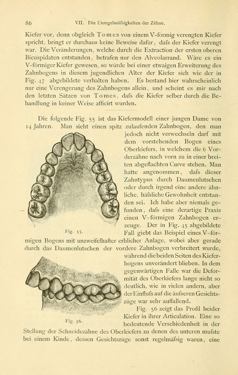 Kiefer vor. denn obgleich Tom es von einem V-förmig verengten Kiefer spricht, bringt er durchaus keine Beweise dafür, dafs der Kiefer verengt war. Die Veränderungen, welche durch die Extraction der ersten oberen Bicuspidaten entstanden, betrafen nur den Alveolarrand. Wäre es ein V-förmiger Kiefer gewesen, so würde bei einer etwaigen Erweiterung des Zahnbogens in diesem jugendlichen Alter der Kiefer sich wie der in Fig. 47 abgebildete verhalten haben. Es bestand hier wahrscheinlich nur eine Verengerung des Zahnbogens allein, und scheint es mir nach den letzten Sätzen von Tomes, dafs die Kiefer selber durch die Be- handlunsr in keiner Weise afficirt wurden. Die folgende Fig. 55 ist das Kiefermodell einer jungen Dame von 14 Jahren. Man sieht einen spitz zulaufenden Zahnbogen, den man jedoch nicht verwechseln darf mit dem vorstehenden Bogen eines Oberkiefers, in welchem die 6 Vor- derzähne nach vorn zu in einer brei- ten abgeflachten Curve stehen. Man hatte angenommen, dafs dieser Zahntypus durch Daumenlutschen oder durch irgend eine andere ähn- liche, häfsliche Gewohnheit entstan- den sei. Ich habe aber niemals ge- funden , dafs eine derartige Praxis einen V-förmigen Zahnbogen er- zeuge. Der in Fig. 45 abgebildete Fall giebt das Beispiel eines V-för- i'ig- 55- migen Bogens mit unzweifelhafter erblicher Anlage, wobei aber gerade durch das Daumenlutschen der vordere Zahnbogen verbreitert wurde, während die beiden Seiten des Kiefer- bogens unverändert blieben. In dem gegenwärtigen Falle war die Defor- mität des Oberkiefers lange nicht so deutlich, wie in vielen andern, aber derEinflufs auf die äufseren Gesichts- züge war sehr auffallend. Fig. 56 zeigt das Profil beider Kiefer in ihrer Articulation. Eine so bedeutende Verschiedenheit in der Fig- 56- Stellung der Schneidezähne des Oberkiefers zu denen des unteren mufste bei einem Kinde, dessen Gesichtszüge sonst regelmäfsig waren, eine