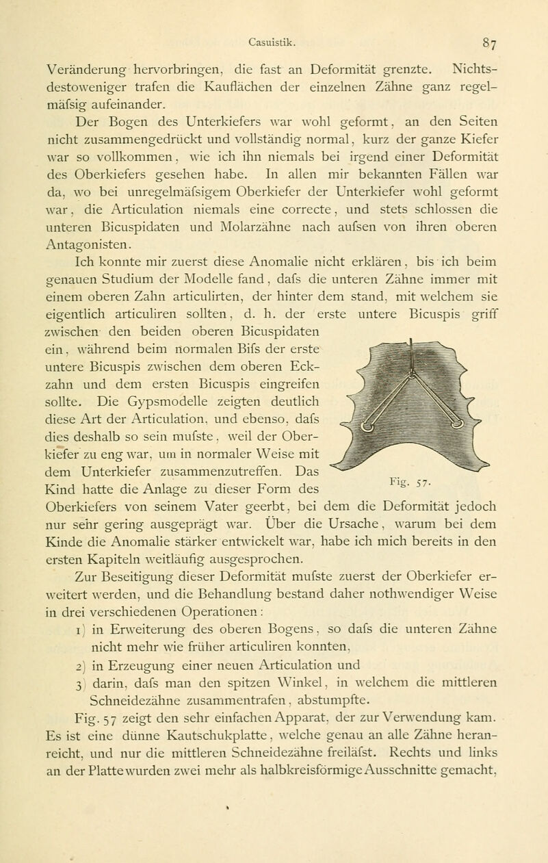 Veränderung hervorbringen, die fast an Deformität grenzte. Nichts- destoweniger trafen die Kauflächen der einzelnen Zähne ganz regel- mäfsig aufeinander. Der Bogen des Unterkiefers war wohl geformt. an den Seiten nicht zusammengedrückt und v^ollständig normal, kurz der ganze Kiefer war so vollkommen. wie ich ihn niemals bei irgend einer Deformität des Oberkiefers gesehen habe. In allen mir bekannten Fällen war da, wo bei unregelmäfsigem Oberkiefer der Unterkiefer wohl geformt war. die Articulation niemals eine correcte, und stets schlössen die unteren Bicuspidaten und Molarzähne nach aufsen von ihren oberen Antagonisten. Ich konnte mir zuerst diese Anomalie nicht erklären. bis ich beim genauen Studium der Modelle fand. dafs die unteren Zähne immer mit einem oberen Zahn articulirten, der hinter dem stand, mit welchem sie eigentlich articuliren sollten, d. h. der erste untere Bicuspis griff zwischen den beiden oberen Bicuspidaten ein. während beim normalen Bifs der erste untere Bicuspis zwischen dem oberen Eck- zahn und dem ersten Bicuspis eingreifen sollte. Die Gypsmodelle zeigten deutlich diese Art der xA-rticulation, und ebenso, dafs dies deshalb so sein mufste, weil der Ober- kiefer zu eng war, um in normaler Weise mit dem Unterkiefer zusammenzutreffen. Das Kind hatte die Anlage zu dieser Form des Oberkiefers von seinem Vater geerbt, bei dem die Deformität jedoch nur sehr gering ausgeprägt war. Über die Ursache, warum bei dem Kinde die AnomaHe stärker entwickelt war, habe ich mich bereits in den ersten Kapiteln weitläufig ausgesprochen. Zur Beseitigung dieser Deformität mufste zuerst der Oberkiefer er- weitert werden, und die Behandlung bestand daher nothwendiger Weise in drei verschiedenen Operationen : i) in Erweiterung des oberen Bogens, so dafs die unteren Zähne nicht mehr wie früher articuliren konnten. 2) in Erzeugung einer neuen Articulation und 3 darin, dafs man den spitzen Winkel, in welchem die mittleren Schneidezähne zusammentrafen. abstumpfte. Fig. 57 zeigt den sehr einfachen Apparat, der zur Venvendung kam. Es ist eine dünne Kautschukplatte, welche genau an alle Zähne heran- reicht, und nur die mittleren Schneidezähne freiläfst. Rechts und links an der Platte wurden zwei melir als halbkreisförmige Ausschnitte gemacht.