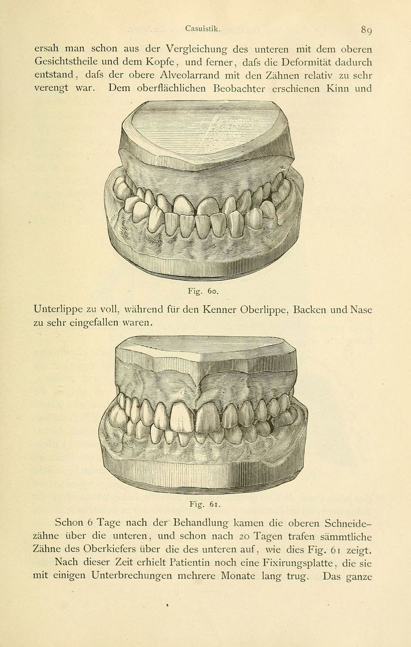 ersah man schon aus der Vergleichung des unteren mit dem oberen Gesichtstheile und dem Kopfe, und ferner, dafs die Deformität dadurch entstand, dafs der obere Alveolarrand mit den Zähnen relativ zu sehr verengt war. Dem oberflächlichen Beobachter erschienen Kinn und Fig. 60. Unterlippe zu voll, während für den Kenner Oberlippe, Backen und Nase zu sehr eingefallen waren. Fig. 61. Schon 6 Tage nach der Behandlung kamen die oberen Schneide- zähne i-iber die unteren, und schon nach 20 Tagen trafen sämmtliche Zähne des Oberkiefers über die des unteren auf, wie dies Fig. 61 zeigt. Nach dieser Zeit erhielt Patientin noch eine Fixirungsplatte, die sie mit einigen Unterbrechungen mehrere Monate lang trug. Das ganze