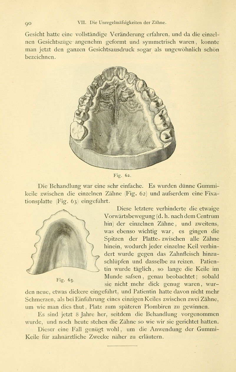 QO Gesicht hatte eine vollständige Veränderung erfahren, und da die einzel- nen Gesichtszüge angenehm geformt und symmetrisch waren, konnte man jetzt den ganzen Gesichtsausdruck sogar als ungewöhnlich schön bezeichnen. Fig. 62. Die Behandlung war eine sehr einfache. Es wurden dünne Gummi- keile zwischen die einzelnen Zähne (Fig. 62) und aufserdem eine Fixa- tionsplatte (Fig. 63) eingeführt. Diese letztere verhinderte die etwaige Vorwärtsbewegung (d. h. nach dem Centrum hin) der einzelnen Zähne, und zweitens, was ebenso wichtig war, es gingen die Spitzen der Platte, zwischen alle Zähne hinein, wodurch jeder einzelne Keil verhin- dert wurde gegen das Zahnfleisch hinzu- schlüpfen und dasselbe zu reizen. Patien- tin wurde täglich. so lange die Keile im Munde safsen, genau beobachtet; sobald sie nicht mehr dick genug waren, wur- den neue, etwas dickere eingeführt, und Patientin hatte davon nicht mehr Schmerzen, als bei Einführung eines einzigen Keiles zwischen zwei Zähne, um wie man dies thut, Platz zum späteren Plombiren zu gewinnen. Es sind jetzt 8 Jahre her, seitdem die Behandlung vorgenommen wurde, und noch heute stehen die Zähne so wie wir sie gerichtet hatten. Dieser eine Fall genügt wohl, um die Anwendung der Gummi- Keile für zahnärztliche Zwecke näher zu erläutern. Fig. 63.