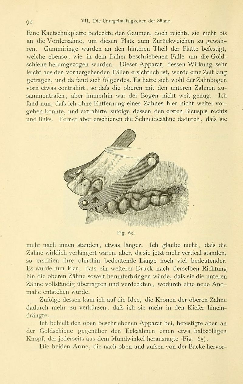 Eine Kautschukplatte bedeckte den Gaumen, doch reichte sie nicht bis an die Vorderzähne, um diesen Platz zum Zurückweichen zu gewäh- ren. Gummiringe wurden an den hinteren Theil der Platte befestigt, welche ebenso, wie in dem früher beschriebenen Falle um die Gold- schiene herumgezogen wurden. Dieser Apparat, dessen Wirkung sehr leicht aus den vorhergehenden Fällen ersichtlich ist, wurde eine Zeit lang getragen, und da fand sich folgendes. Es hatte sich wohl der Zahnbogen vorn etwas contrahirt, so dafs die oberen mit den unteren Zähnen zu- sammentrafen , aber immerhin war der Bogen nicht weit genug. Ich fand nun. dafs ich ohne Entfernung eines Zahnes hier nicht weiter vor- gehen konnte, und extrahirte zufolge dessen den ersten Bicuspis rechts und links. Ferner aber erschienen die Schneidezähne dadurch, dafs sie Fig. 65. mehr nach innen standen, etwas länger. Ich glaube nicht, dafs die Zähne wirklich verlängert waren, aber, da sie jetzt mehr vertical standen, so erschien ihre ohnehin bedeutende Länge noch viel bedeutender. Es wurde nun klar, dafs ein weiterer Druck nach derselben Richtung hin die oberen Zähne soweit herunterbringen würde, dafs sie die unteren Zähne vollständig überragten und verdeckten, wodurch eine neue Ano- malie entstehen würde. Zufolge dessen kam ich auf die Idee, die Kronen der oberen Zähne dadurch mehr zu verkürzen, dafs ich sie mehr in den Kiefer hinein- drängte. Ich behielt den oben beschriebenen Apparat bei, befestigte aber an der Goldschiene gegenüber den Eckzähnen einen etwa halbzöUigen Knopf, der jederseits aus dem Mundwinkel hcrausragte (Fig. 65). Die beiden Arme, die nach oben und aufscn von der Backe hervor-