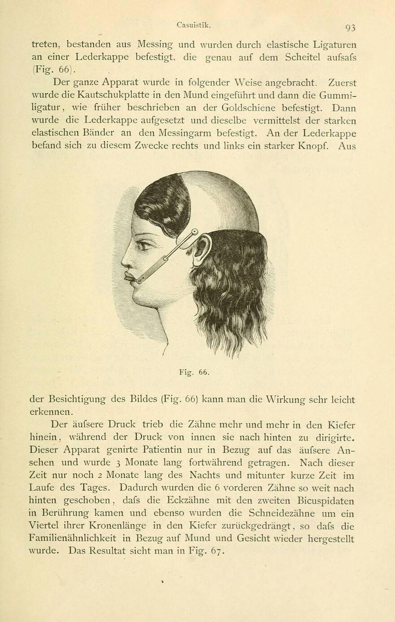 treten, bestanden aus Messing und wurden durch elastische Ligaturen an einer Lederkappe befestigt, die genau auf dem Scheitel aufsafs (Fig. 66). Der ganze Apparat wurde in folgender Weise angebracht. Zuerst wurde die Kautschukplatte in den Mund eingeführt und dann die Gummi- ligatur , wie früher beschrieben an der Goldschiene befestigt. Dann wurde die Lederkappe aufgesetzt und dieselbe vermittelst der starken elastischen Bänder an den Messingarm befestigt. An der Lederkappe befand sich zu diesem Zwecke rechts und links ein starker Knopf. Aus Fie:. 66. der Besichtigung des Bildes (Fig. 66) kann man die Wirkung sehr leicht erkennen. Der äufsere Druck trieb die Zähne mehr und mehr in den Kiefer hinein, während der Druck von innen sie nach hinten zu dirigirte. Dieser Apparat genirte Patientin nur in Bezug auf das äufsere An- sehen und wurde 3 Monate lang fortwährend getragen. Nach dieser Zeit nur noch 2 Monate lang des Nachts und mitunter kurze Zeit im Laufe des Tages. Dadurch wurden die 6 vorderen Zähne so weit nach hinten geschoben, dafs die Eckzähne mit den zweiten Bicuspidaten in Berührung kamen und ebenso wurden die Schneidezähne um ein Viertel ihrer Kronenlänge in den Kiefer zurückgedrängt, so dafs die Familienähnlichkeit in Bezug auf Mund und Gesicht wieder hergestellt wurde. Das Resultat sieht man in Fig. 67.