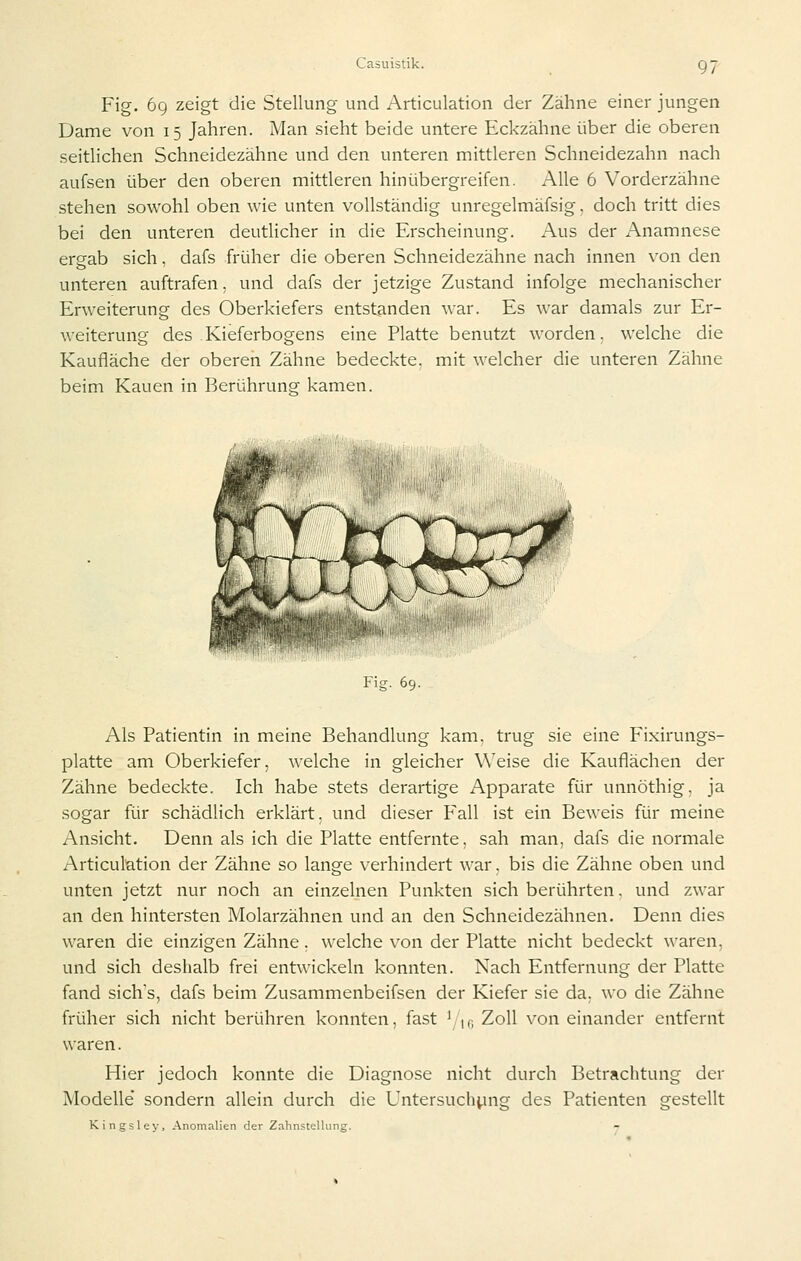 Fig. 6q zeigt die Stellung und Articulation der Zähne einer jungen Dame von 15 Jahren. Man sieht beide untere Eckzähne über die oberen seitlichen Schneidezähne und den unteren mittleren Schneidezahn nach aufsen über den oberen mittleren hinübergreifen. Alle 6 Vorderzähne stehen sowohl oben wie unten vollständig unregelmäfsig. doch tritt dies bei den unteren deuthcher in die Erscheinung. Aus der Anamnese ergab sich, dafs früher die oberen Schneidezähne nach innen von den unteren auftrafen, und dafs der jetzige Zustand infolge mechanischer Erweiterung des Oberkiefers entstanden war. Es w'ar damals zur Er- weiterung des Kieferbogens eine Platte benutzt worden, welche die Kaufläche der oberen Zähne bedeckte, mit welcher die unteren Zähne beim Kauen in Berührung kamen. Fig. 69. Als Patientin in meine Behandlung kam. trug sie eine Fixirungs- platte am Oberkiefer, welche in gleicher Weise die Kauflächen der Zähne bedeckte. Ich habe stets derartige Apparate für unnöthig, ja sogar für schädlich erklärt, und dieser Fall ist ein Beweis für meine Ansicht. Denn als ich die Platte entfernte, sah man, dafs die normale Articulation der Zähne so lange verhindert war, bis die Zähne oben und unten jetzt nur noch an einzelnen Punkten sich berührten. und zwar an den hintersten Molarzähnen und an den Schneidezähnen. Denn dies waren die einzigen Zähne. welche von der Platte nicht bedeckt waren, und sich deshalb frei entwickeln konnten. Nach Entfernung der Platte fand sich's, dafs beim Zusammenbeifsen der Kiefer sie da, wo die Zähne früher sich nicht berühren konnten, fast 'if, Zoll von einander entfernt waren. Hier jedoch konnte die Diagnose nicht durch Betrachtung der Modelle' sondern allein durch die Untersuchung des Patienten gestellt Kingsley. Anomalien der Zahnstellung.