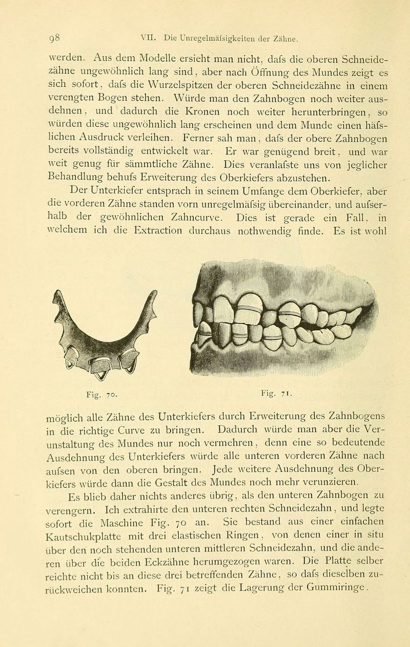 werden. Aus dem Modelle ersieht man nicht, dafs die oberen Schneide- zähne ungewöhnlich lang sind, aber nach Öffnung des Mundes zeigt es sich sofort, dafs die Wurzelspitzen der oberen Schneidezähne in einem verengten Bogen stehen. Würde man den Zahnbogen noch weiter aus- dehnen . und dadurch die Kronen noch weiter herunterbring-en, so würden diese ungewöhnHch lang erscheinen und dem Munde einen häfs- lichen i\usdruck verleihen. Ferner sah man, dafs der obere Zahnbogen bereits vollständig entwickelt war. Er war genügend breit, und war weit genug für sämmthche Zähne. Dies veranlafste uns von jeglicher Behandlung behufs Erweiterung des Oberkiefers abzustehen. Der Unterkiefer entsprach in seinem Umfange dem Oberkiefer, aber die vorderen Zähne standen vorn unregelmäfsig übereinander, und aufser- halb der gewöhnlichen Zahncurve. Dies ist gerade ein Fall, in welchem ich die Extraction durchaus nothwendig finde. Es ist wohl Fig. 70. Fig. 71. möglich alle Zähne des Unterkiefers durch Erweiterung des Zahnbogens in die richtige Curve zu bringen. Dadurch würde man aber die Ver- unstaltung des Mundes nur noch vermehren, denn eine so bedeutende Ausdehnung des Unterkiefers würde alle unteren vorderen Zähne nach aufsen von den oberen bringen. Jede weitere Ausdehnung des Ober- kiefers würde dann die Gestalt des Mundes noch mehr verunzieren. Es blieb daher nichts anderes übrig, als den unteren Zahnbogen zu verengern. Ich extrahirte den unteren rechten Schneidezahn, und legte sofort die Maschine Fig. 70 an. Sie bestand aus einer einfachen Kautschukplattc mit drei elastischen Ringen, von denen einer in situ über den noch stehenden unteren mittleren Schneidezahn, und die ande- ren über die beiden Eckzähne herumgezogen waren. Die Platte selber reichte nicht bis an diese drei betreffenden Zähne, so dafs dieselben zu- rückweichen konnten. Fig. 71 zeigt die Lagerung der Gummiringe .