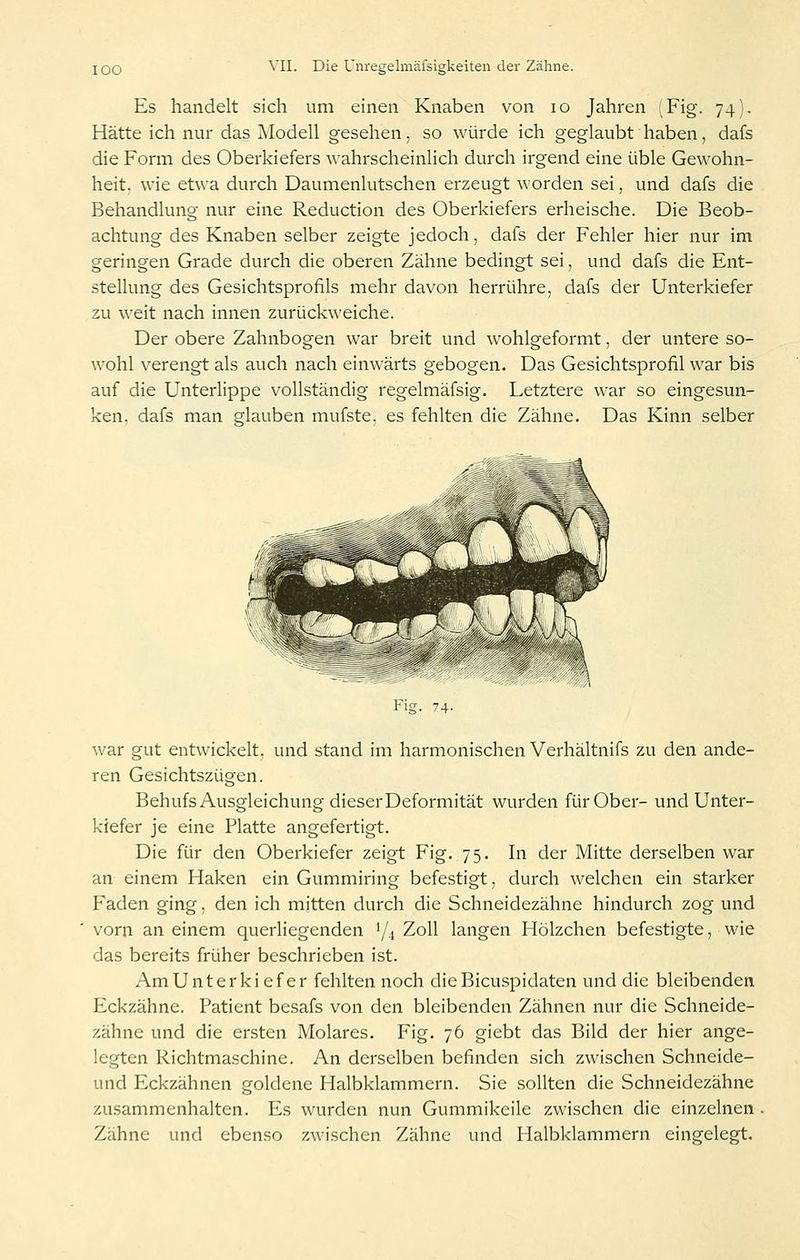 Es handelt sich um einen Knaben von lo Jahren (Fig. 74). Hätte ich nur das Modell gesehen, so würde ich geglaubt haben, dafs die Form des Oberkiefers wahrscheinlich durch irgend eine üble Gewohn- heit, wie etwa durch Daumenlutschen erzeugt worden sei, und dafs die Behandlung nur eine Reduction des Oberkiefers erheische. Die Beob- achtung des Knaben selber zeigte jedoch, dafs der Fehler hier nur im geringen Grade durch die oberen Zähne bedingt sei, und dafs die Ent- stellung des Gesichtsprofils mehr davon herrühre, dafs der Unterkiefer zu weit nach innen zurückweiche. Der obere Zahnbogen war breit und wohlgeformt, der untere so- wohl verengt als auch nach einwärts gebogen. Das Gesichtsprofil war bis auf die Unterlippe vollständig regelmäfsig. Letztere war so eingesun- ken, dafs man sflauben mufste. es fehlten die Zähne. Das Kinn selber Fig. 74- war gut entwickelt, und stand im harmonischen Verhältnifs zu den ande- ren Gesichtszügen. Behufs Ausgleichung dieser Deformität wurden für Ober- und Unter- kiefer je eine Platte angefertigt. Die für den Oberkiefer zeigt Fig. 75. In der Mitte derselben war an einem Haken ein Gummiring befestigt, durch welchen ein starker Faden ging, den ich mitten durch die Schneidezähne hindurch zog und vorn an einem querliegenden 1/4 Zoll langen Hölzchen befestigte, wie das bereits früher beschrieben ist. Am Unterkiefer fehlten noch dicBicuspidaten und die bleibenden Eckzähne. Patient besafs von den bleibenden Zähnen nur die Schneide- zähne und die ersten Molares. Fig. 76 giebt das Bild der hier ange- legten Richtmaschine. An derselben befinden sich zwischen Schneide- und Eckzähnen goldene Halbklammern. Sie sollten die Schneidezähne zusammenhalten. Es wurden nun Gummikeile zwischen die einzelnen Zähne und ebenso zwischen Zähne und Halbklammern eingelegt.