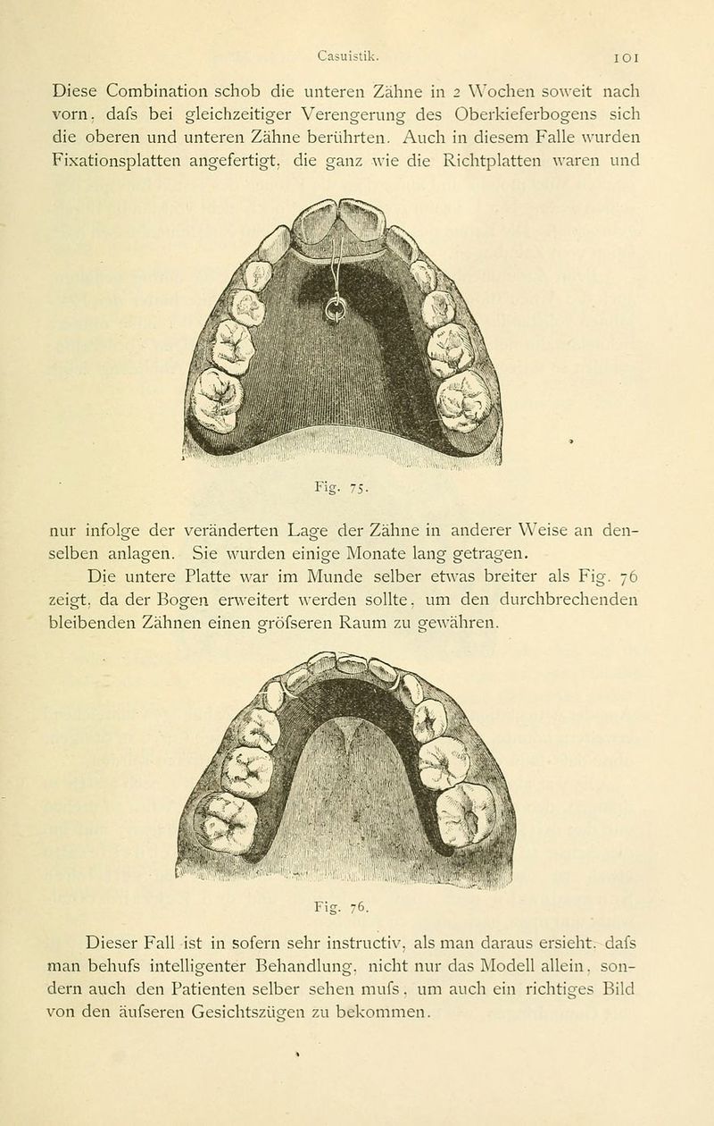 Diese Comblnation schob die unteren Zähne in 2 Wochen soweit nach vorn, dafs bei gleichzeitiger Verengerung des Oberkieferbogens sich die oberen und unteren Zähne berührten. Auch in diesem Falle wurden Fixationsplatten angefertigt, die ganz wie die Richtplatten waren und Fig- 75. nur infolge der veränderten Lage der Zähne in anderer Weise an den- selben anlagen. Sie wurden einige Monate lang getragen. Die untere Platte war im Munde selber etwas breiter als Fig. 76 zeigt; da der Bogen erweitert werden sollte. um den durchbrechenden bleibenden Zähnen einen eröfseren Raum zu sfewähren. Fig. 76. Dieser Fall ist in sofern sehr instructiv. als man daraus ersieht, dafs man behufs intelligenter Behandlung, nicht nur das Modell allein, son- dern auch den Patienten selber sehen mufs. um auch ein richtiges Bild von den äufseren Gesichtszüsfen zu bekommen.