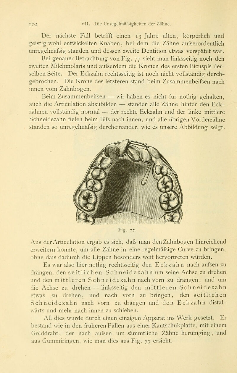 Der nächste Fall betrifft einen 13 Jahre alten, körperlich und geistig wohl entwickelten Knaben, bei dem die Zähne aufserordentlich imregelmäfsig standen und dessen zweite Dentition etwas verspätet war. Bei genauer Betrachtung von Fig. 77 sieht man linksseitig noch den zweiten Milchmolaris und aufserdem die Kronen des ersten Bicuspis der- selben Seite. Der Eckzahn rechtsseitig ist noch nicht vollständig durch- gebrochen. Die Krone des letzteren stand beim Zusammenbeifsen nach innen vom Zahnbogen. Beim Zusammenbeifsen — wir haben es nicht für nöthig gehalten, auch die Articulation abzubilden — standen alle Zähne hinter den Eck- zähnen vollständig normal — der rechte Eckzahn und der linke mittlere Schneidezahn fielen beim Bifs nach innen, und alle übrigen Vorderzähne standen so unregelmäfsig durcheinander, wie es unsere Abbildung zeigt. Fig. 77- Aus der Articulation ergab es sich, dafs man den Zahnbogen hinreichend erweitern konnte, um alle Zähne in eine regelmäfsige Curve zu bringen, ohne dafs dadurch die Lippen besonders weit hervortreten würden. Es war also hier nöthig rechtsseitig den Eckzahn nach aufsen zu drängen, den seitlichen S c h n e i d e z a h n um seine Achse zu drehen und den mittleren Schnei dezahn nach vorn zu drängen, und um die Achse zu drehen — linksseitig den mittleren Schneidezahn etwas zu drehen, und nach vorn zu bringen, den seitlichen Schneidezahn nach vorn zu drängen und den Eckzahn distal- wärts und mehr nach innen zu schieben. All dies wurde durch einen einzigen Apparat ins Werk gesetzt. Er bestand wie in den früheren Fällen aus einer Kautschukplatte, mit einem Golddraht, der nach aufsen um sämmtliche Zähne herumging, und aus Gummiringen, wie man dies aus Fig. 77 ersieht.
