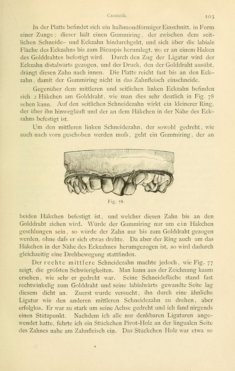 In der Platte befindet sich ein halbmondförmiger Einschnitt, in Form einer Zunge; dieser hält einen Gummiring, der zwischen dem seit- lichen Schneide- und Eckzahn hindurchgeht, und sich über die labiale Fläche des Eckzahns bis zum Bicuspis herumlegt, wo er an einem Haken des Golddrahtes befestigt wird. Durch den Zug der Ligatur wird der Eckzahn distalwärts gezogen, und der Druck, den der Golddraht ausübt, drängt diesen Zahn nach innen. Die Platte reicht fast bis an den Eck- zahn, damit der Gummiring nicht in das Zahnfleisch einschneide. Gegenüber dem mittleren und seitlichen linken Eckzahn befinden sich 2 Häkchen am Golddraht, wie man dies sehr deutlich in Fig. 78 sehen kann. Auf den seitlichen Schneidezahn wirkt ein kleinerer Ring, der über ihn hinwegläuft und der an dem Häkchen in der Nähe des Eck- zahns befestigt ist. Um den mittleren linken Schneidezahn. der sowohl gedreht, wie auch nach vorn geschoben werden mufs. s^eht ein Gummirinsf. der an Fig. 78. beiden Häkchen befestigt ist, und welcher diesen Zahn bis an den Golddraht ziehen wird. Würde der Gummiring nur um ein Häkchen geschlungen sein, so würde der Zahn nur bis zum Golddraht gezogen werden, ohne dafs er sich etwas drehte. Da aber der Ring auch um das Häkchen in der Nähe des Eckzahnes herumgezogen ist, so wird dadurch gleichzeitig eine Drehbewegung stattfinden. Der rechte mittlere Schneidezahn machte jedoch, wie Fig. 77 zeigt, die gröfsten Schwierigkeiten. Man kann aus der Zeichnung kaum ersehen. wie sehr er gedreht war. Seine Schneidefläche stand fast rechtwinkelig zum Golddraht und seine labialwärts gewandte Seite lag diesem dicht an. Zuerst wurde versucht, ihn durch eine ähnliche Ligatur wie den anderen mittleren Schneidezahn zu drehen, aber erfolglos. Er war zu stark um seine Achse gedreht und ich fand nirgends einen Stützpunkt. Nachdem ich alle nur denkbaren Ligaturen ange- wendet hatte, führte ich ein Stückchen Pivot-Holz an der lingualen Seite des Zahnes nahe am Zahnfleisch ein. Das Stückchen Holz war etwa so