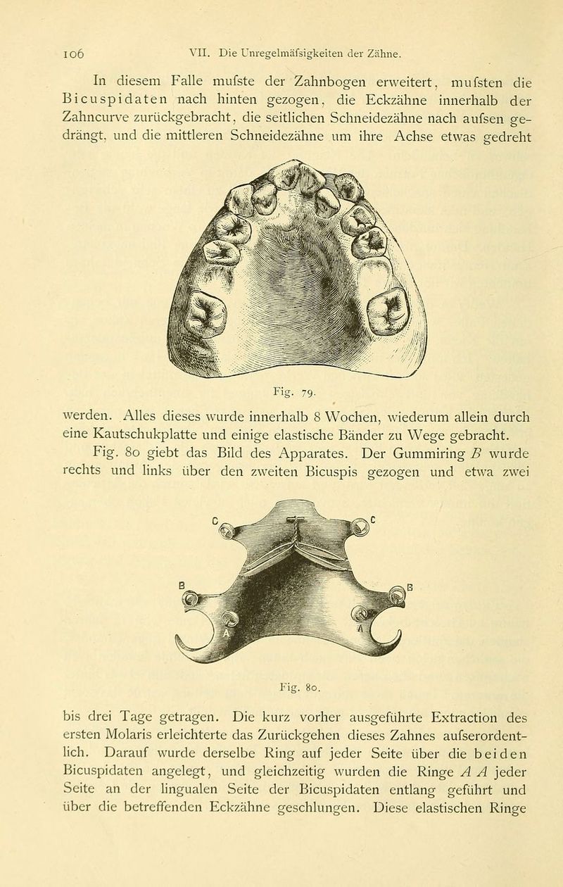 In diesem Falle mufste der Zahnbogen erweitert, mufsten die Bicuspidaten nach hinten gezogen, die Eckzähne innerhalb der Zahncurve zurückgebracht, die seitlichen Schneidezähne nach aufsen ge- drängt, und die mittleren Schneidezähne um ihre Achse etwas gedreht Fig. 79. werden. Alles dieses wurde innerhalb 8 Wochen, wiederum allein durch eine Kautschukplatte und einige elastische Bänder zu Wege gebracht. Fig. 80 giebt das Bild des Apparates. Der Gummiring B wurde rechts und links über den zweiten Bicuspis gezogen und etwa zwei Fig. 80. bis drei Tage getragen. Die kurz vorher ausgeführte Extraction des ersten Molaris erleichterte das Zurückgehen dieses Zahnes aufserordent- lich. Darauf wurde derselbe Ring auf jeder Seite über die beiden Bicuspidaten angelegt, und gleichzeitig wurden die Ringe A A jeder Seite an der lingualen Seite der Bicuspidaten entlang geführt und über die betreffenden Eckzähne geschlungen. Diese elastischen Ringe